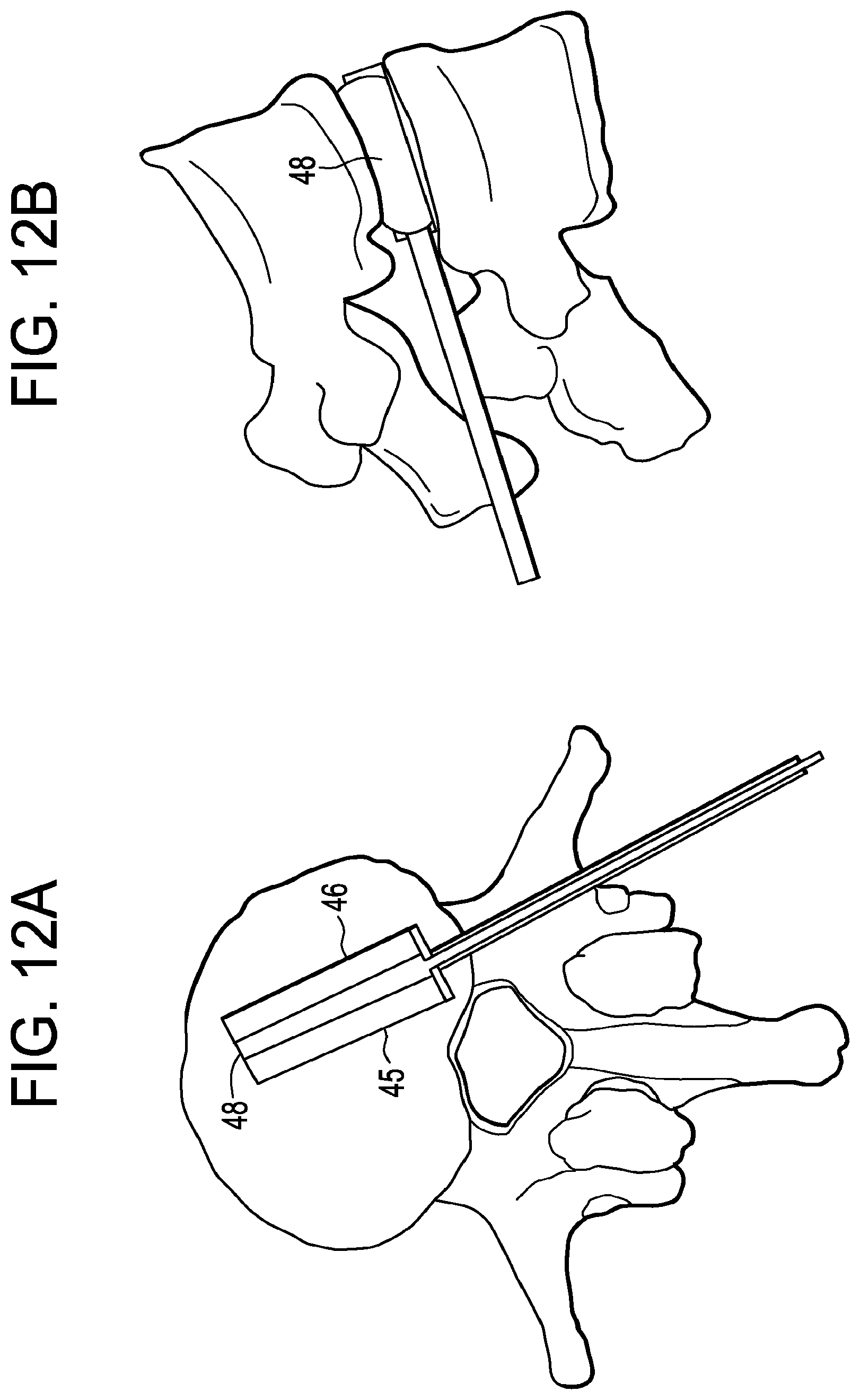 Patent US12426868 Figure 12 – Balloon with shape control for spinal procedures