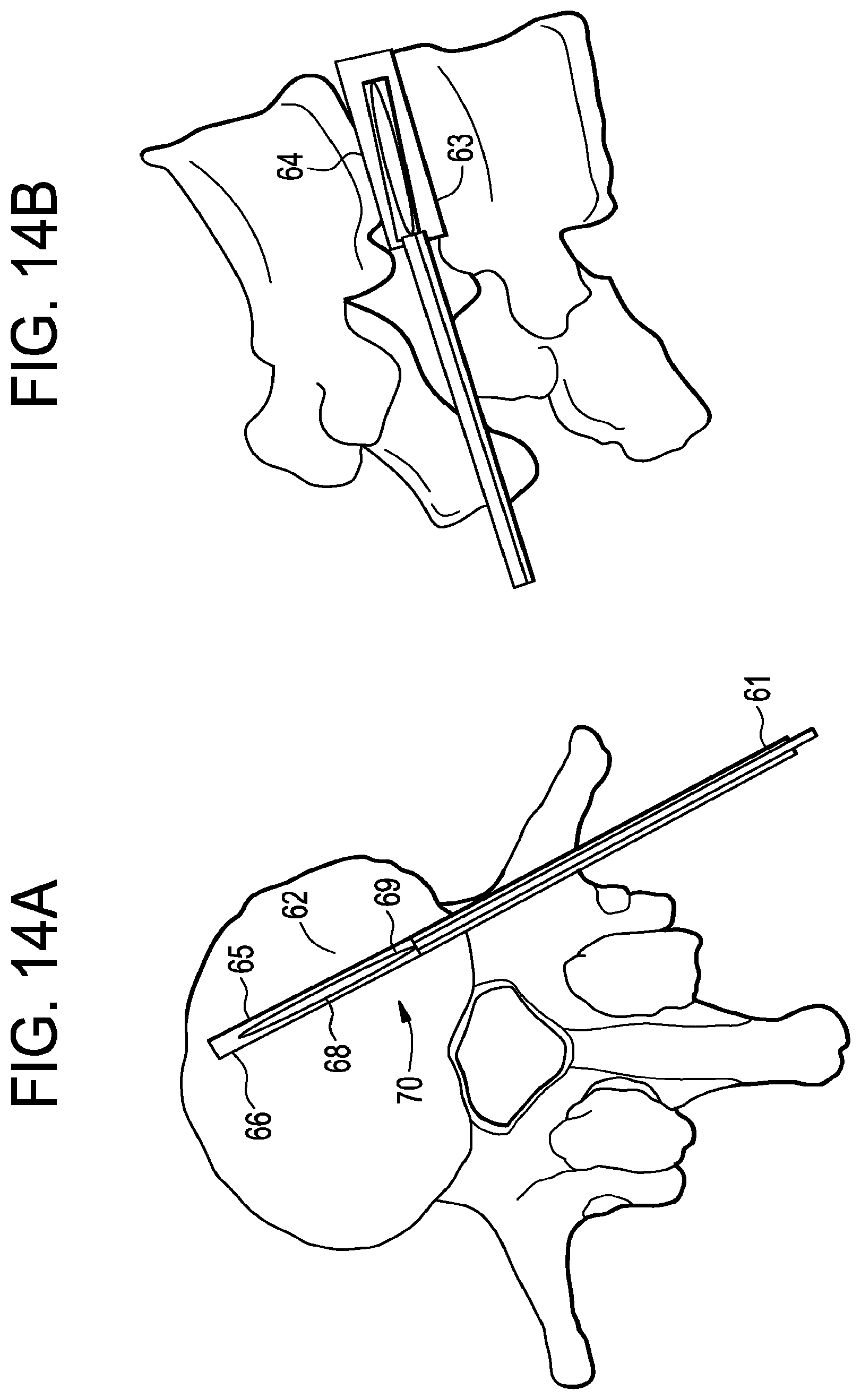 Patent US12426868 Figure 14 – Balloon with shape control for spinal procedures