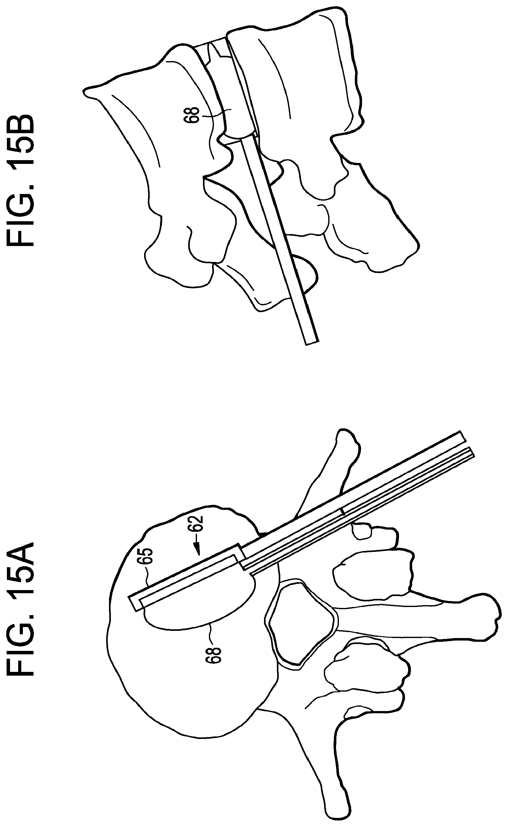 Patent US12426868 Figure 15 – Balloon with shape control for spinal procedures