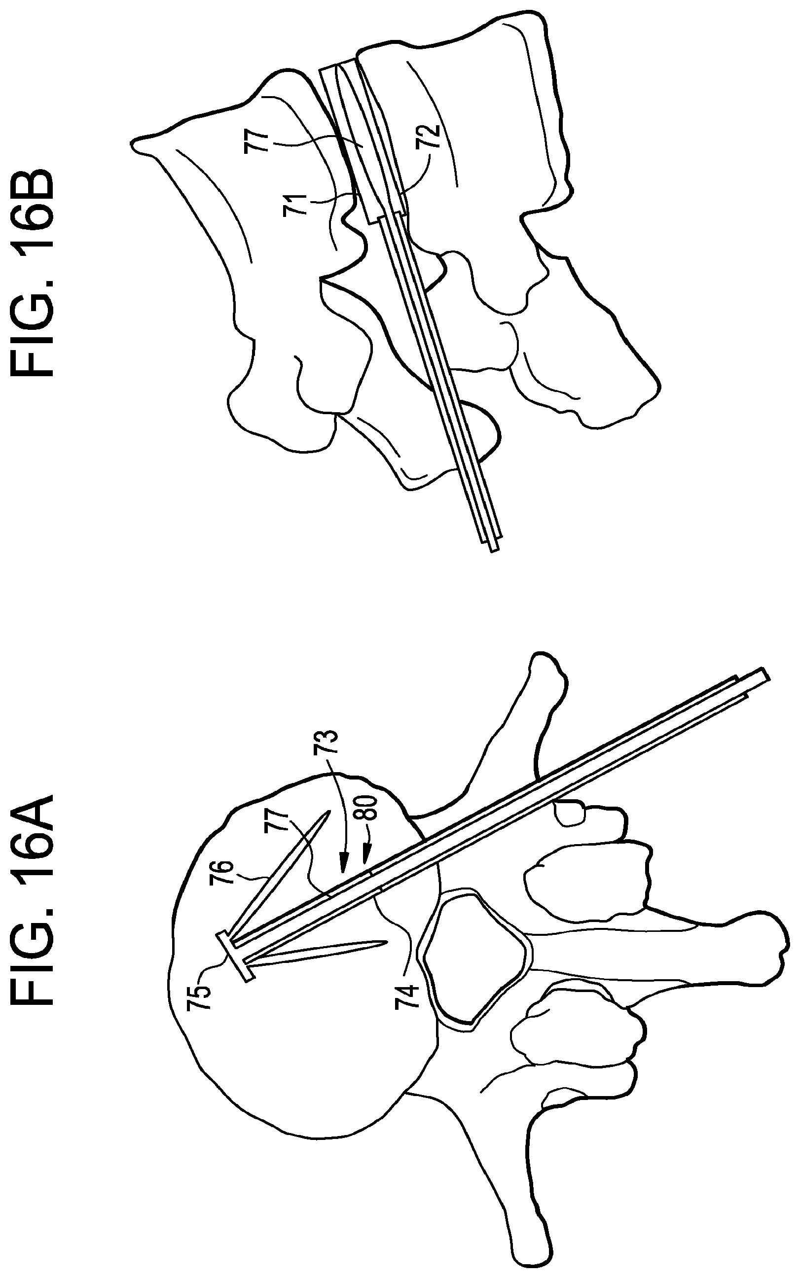 Patent US12426868 Figure 16 – Balloon with shape control for spinal procedures