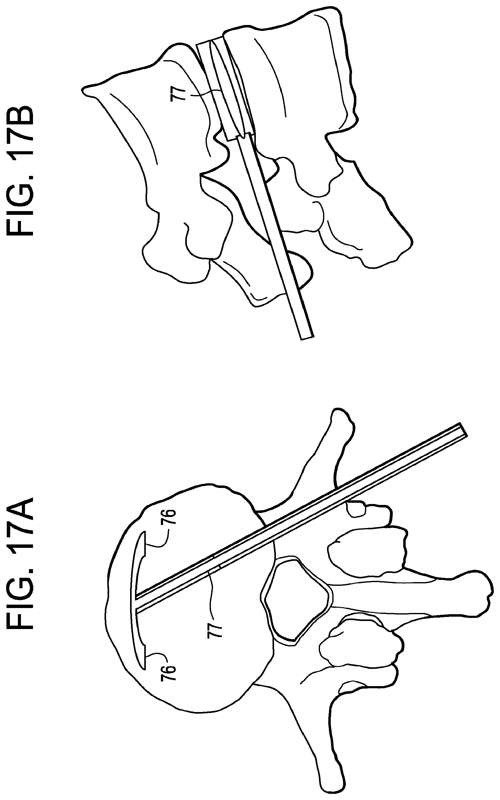 Patent US12426868 Figure 17 – Balloon with shape control for spinal procedures
