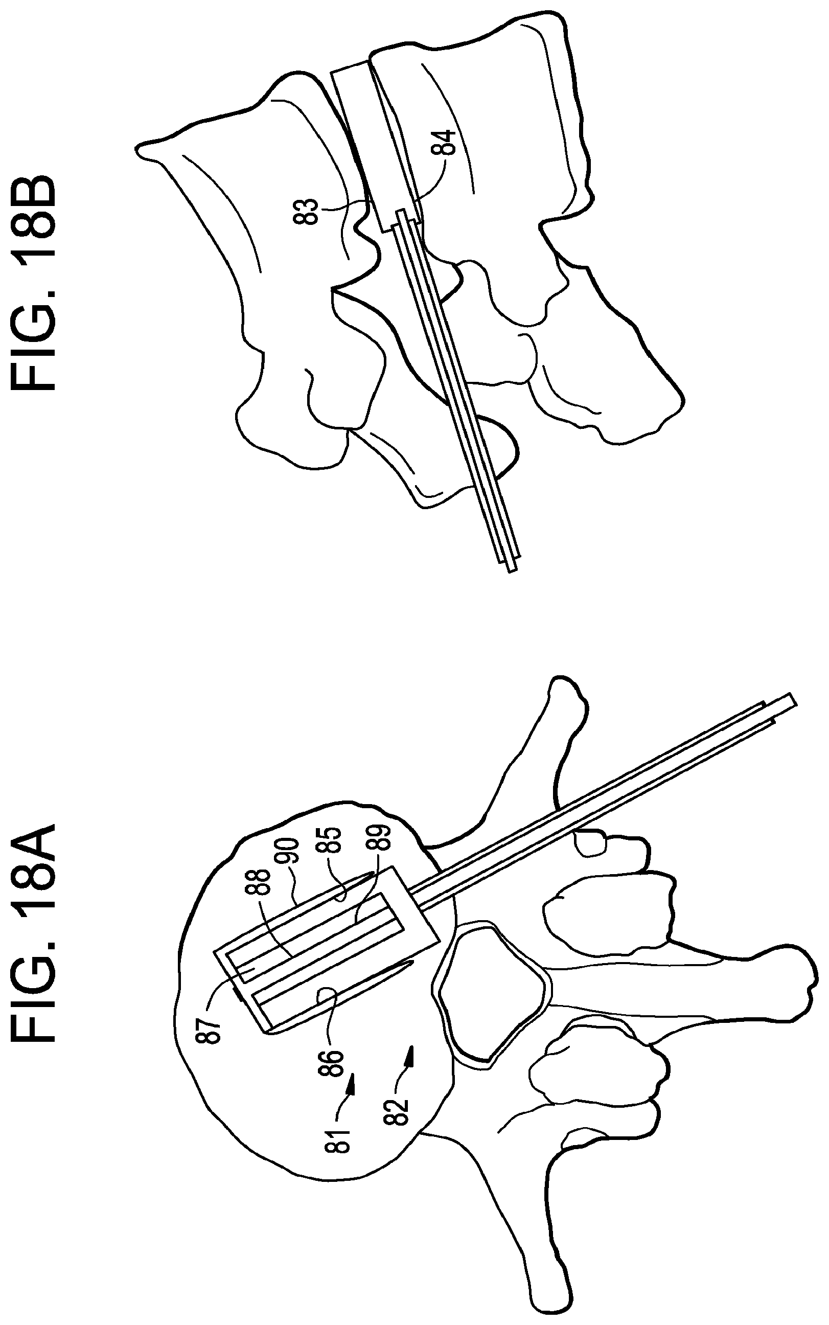 Patent US12426868 Figure 18 – Balloon with shape control for spinal procedures