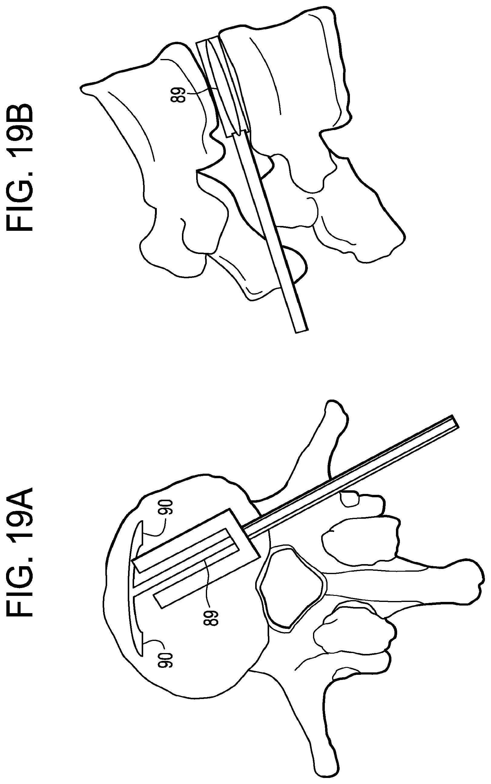 Patent US12426868 Figure 19 – Balloon with shape control for spinal procedures