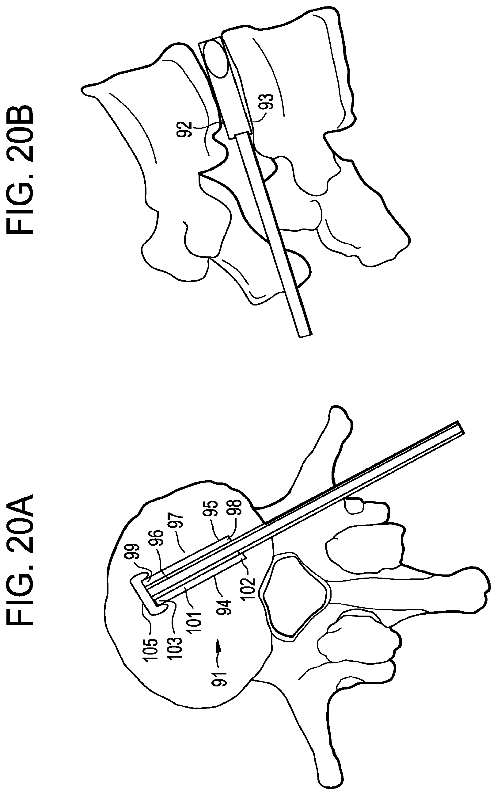 Patent US12426868 Figure 20 – Balloon with shape control for spinal procedures