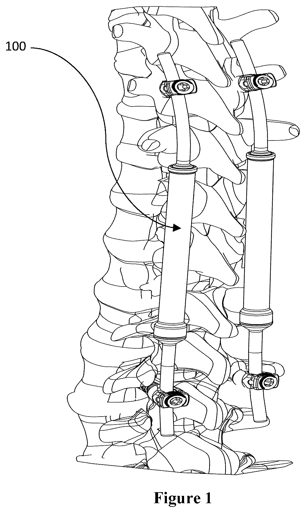 Patent US12426869 Figure 1 – Constant distraction force driven self actuating growing rod systems