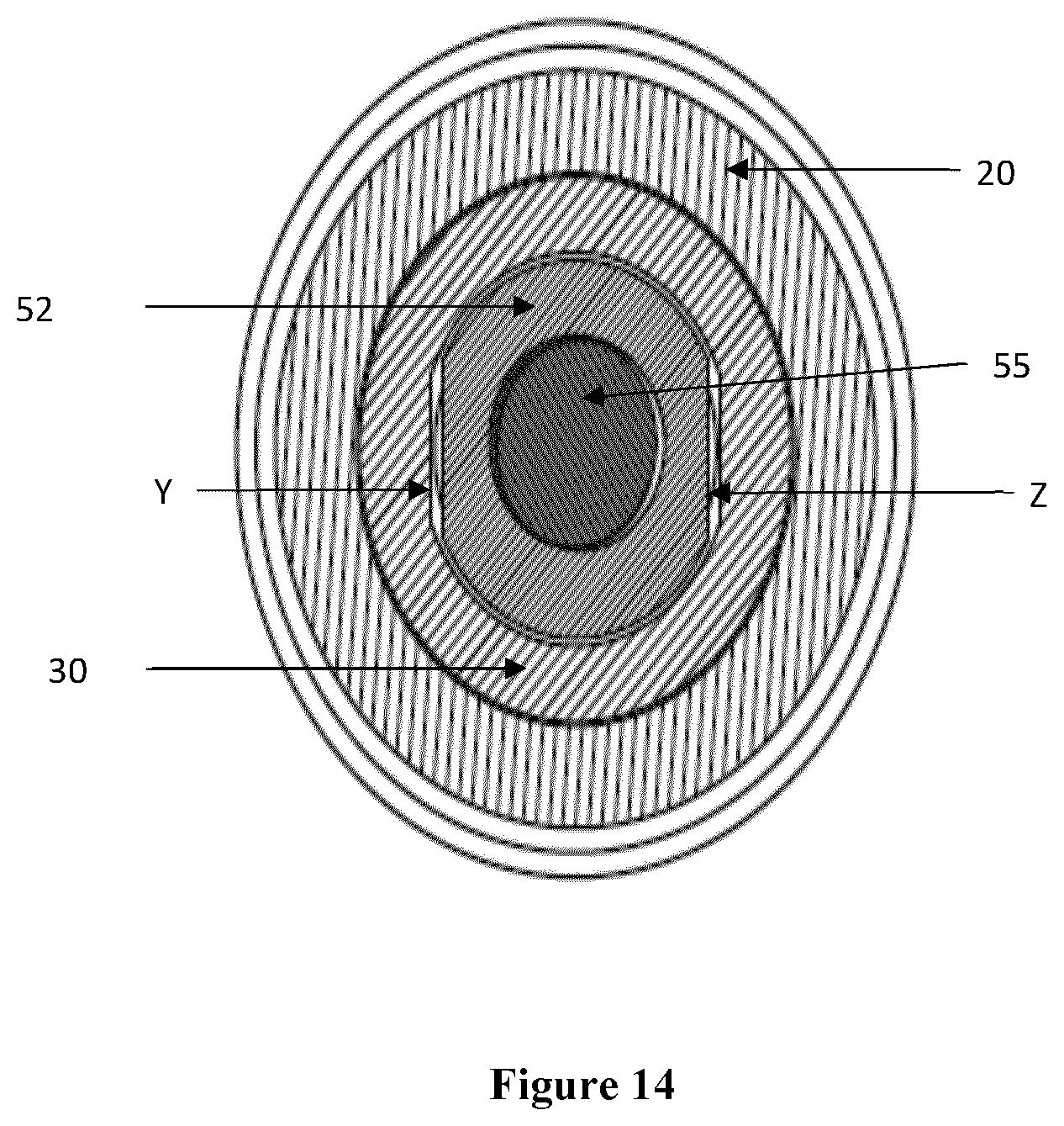 Patent US12426869 Figure 14 – Constant distraction force driven self actuating growing rod systems