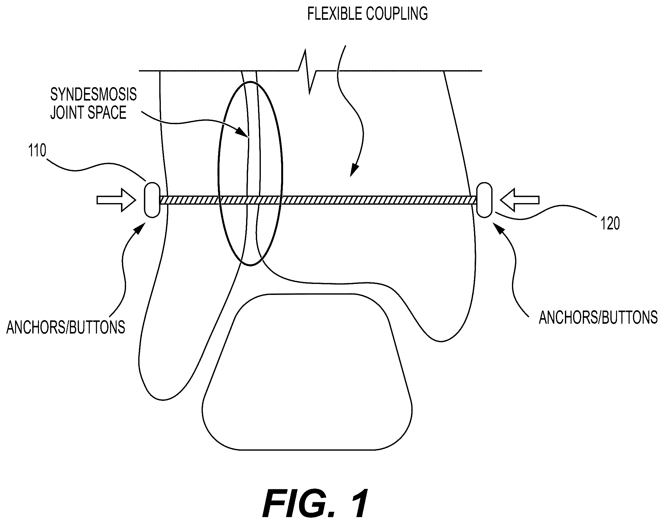 Patent US12426871 Figure 1 – Systems, devices and methods for implanting suture buttons