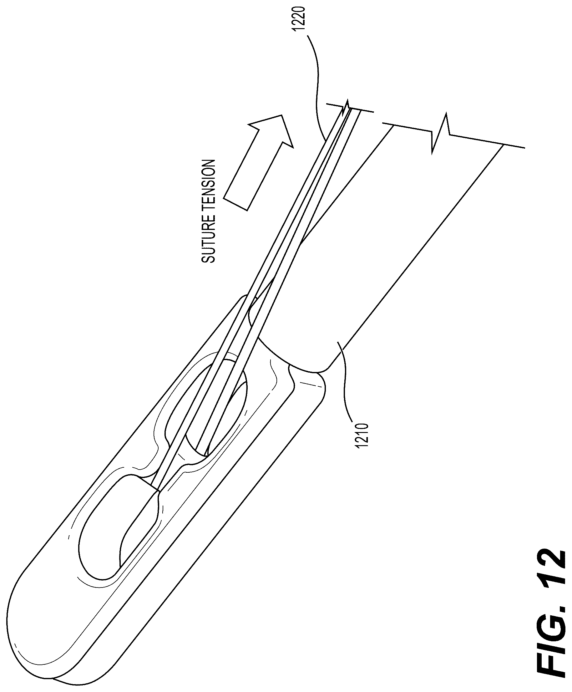 Patent US12426871 Figure 12 – Systems, devices and methods for implanting suture buttons