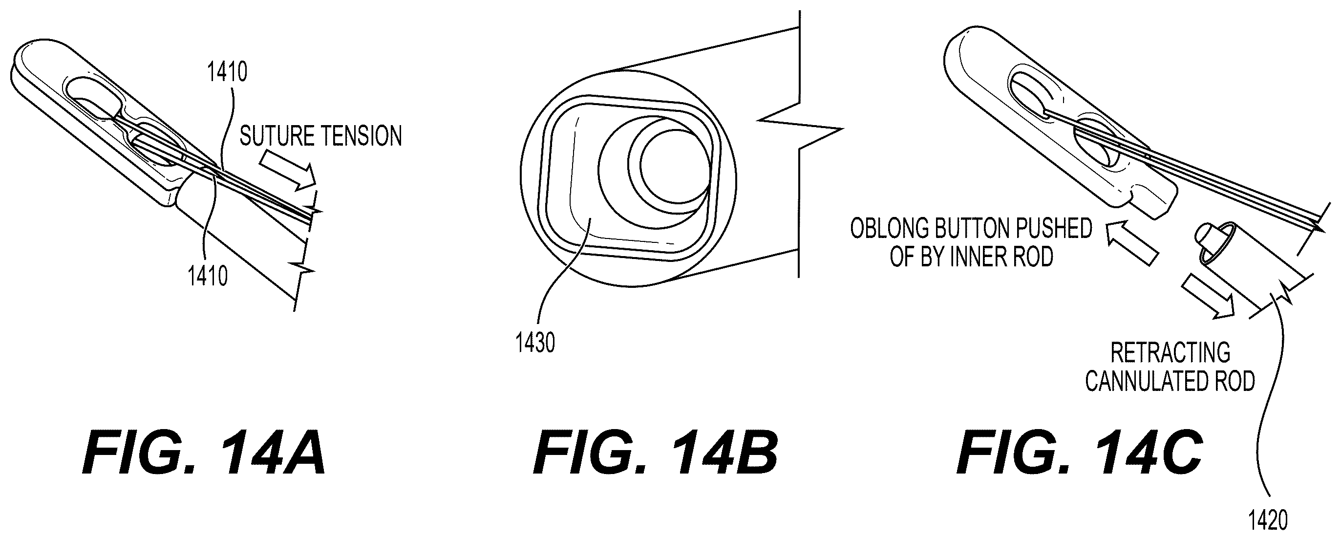 Patent US12426871 Figure 14 – Systems, devices and methods for implanting suture buttons