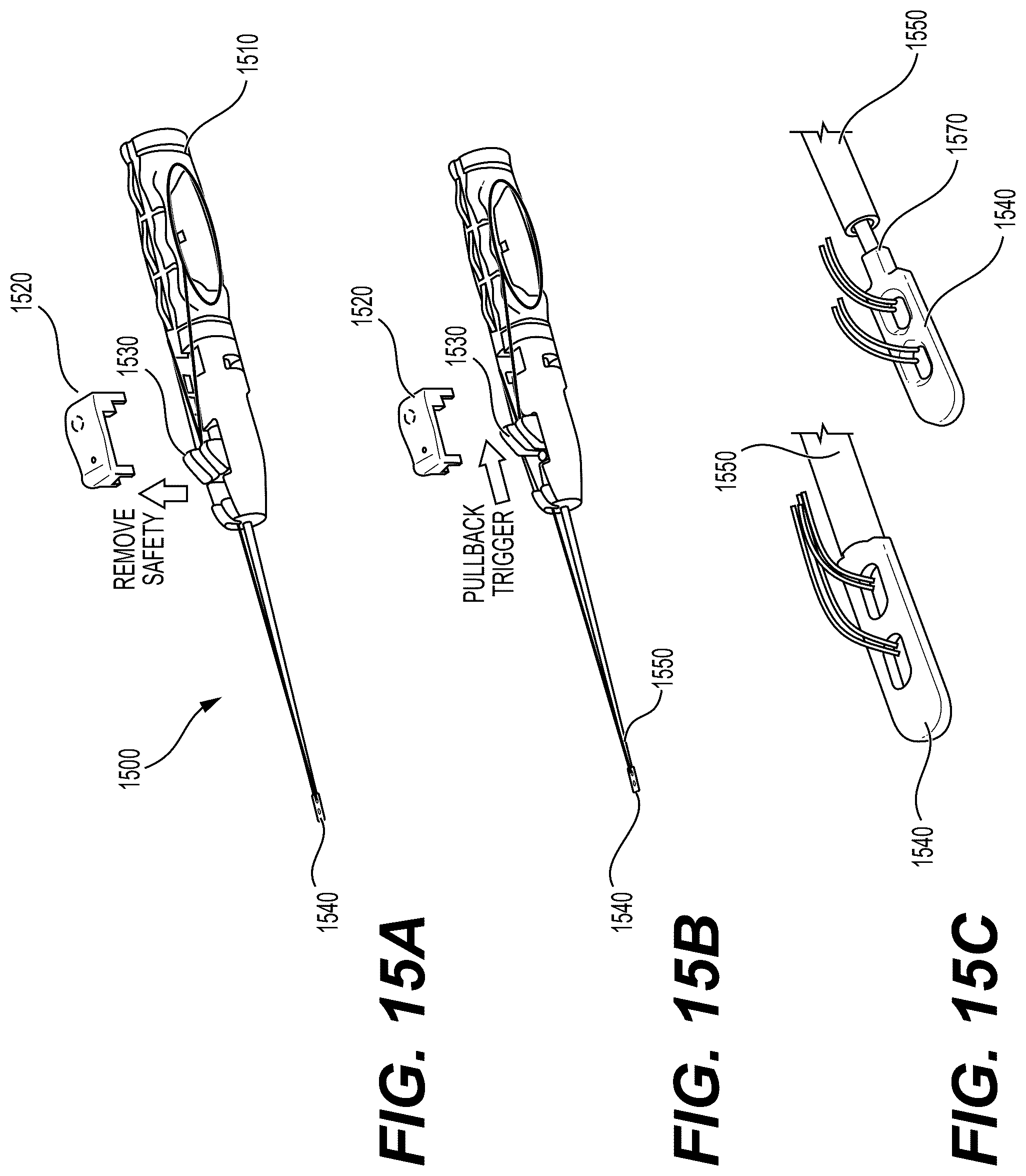 Patent US12426871 Figure 15 – Systems, devices and methods for implanting suture buttons