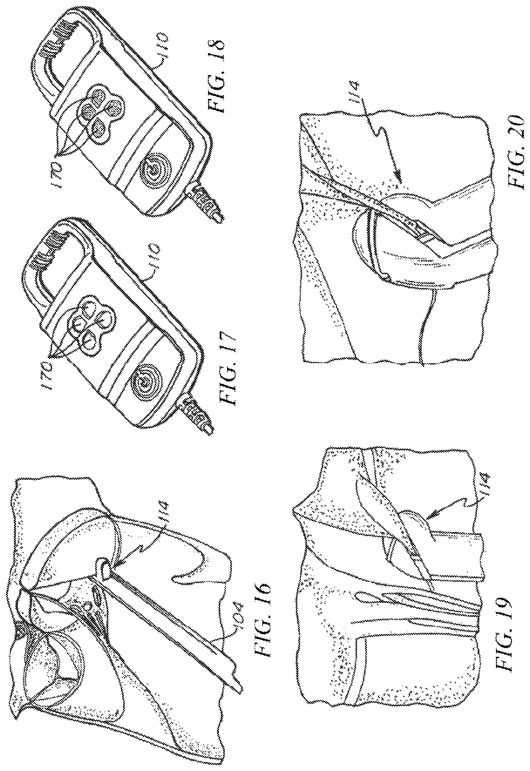 Patent US12426874 Figure 15 – Minimally invasive repair of a valve leaflet in a beating heart