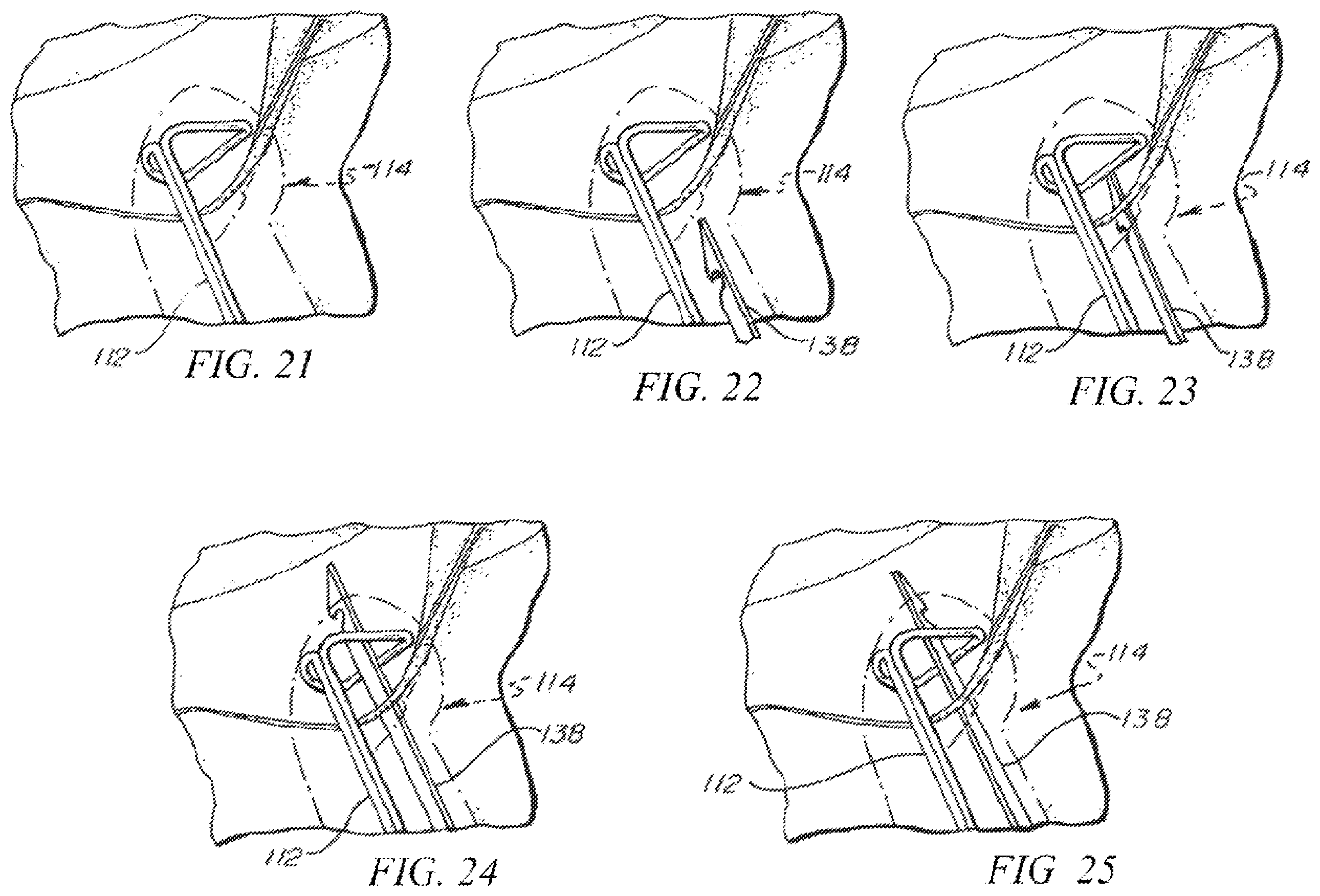 Patent US12426874 Figure 16 – Minimally invasive repair of a valve leaflet in a beating heart