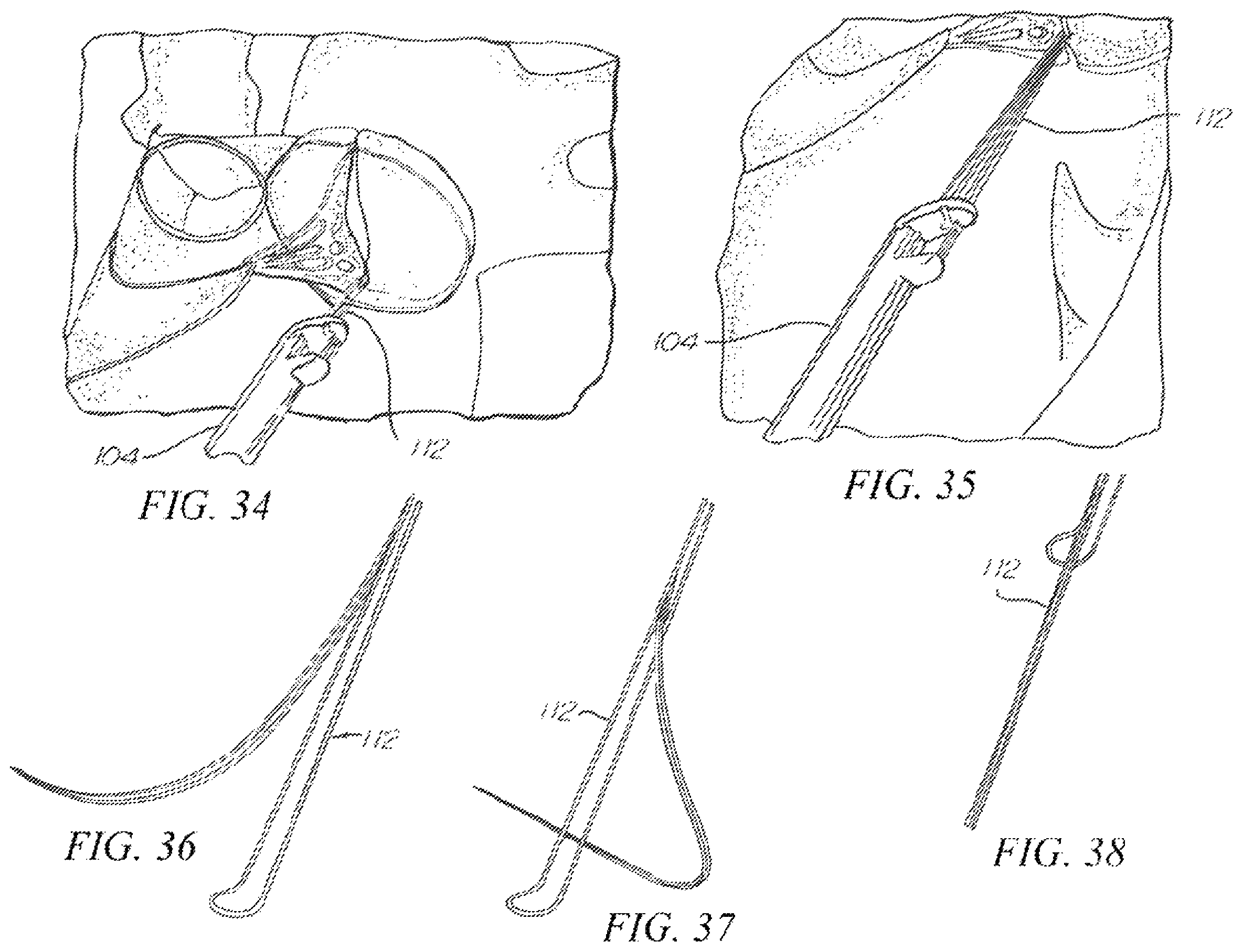 Patent US12426874 Figure 19 – Minimally invasive repair of a valve leaflet in a beating heart
