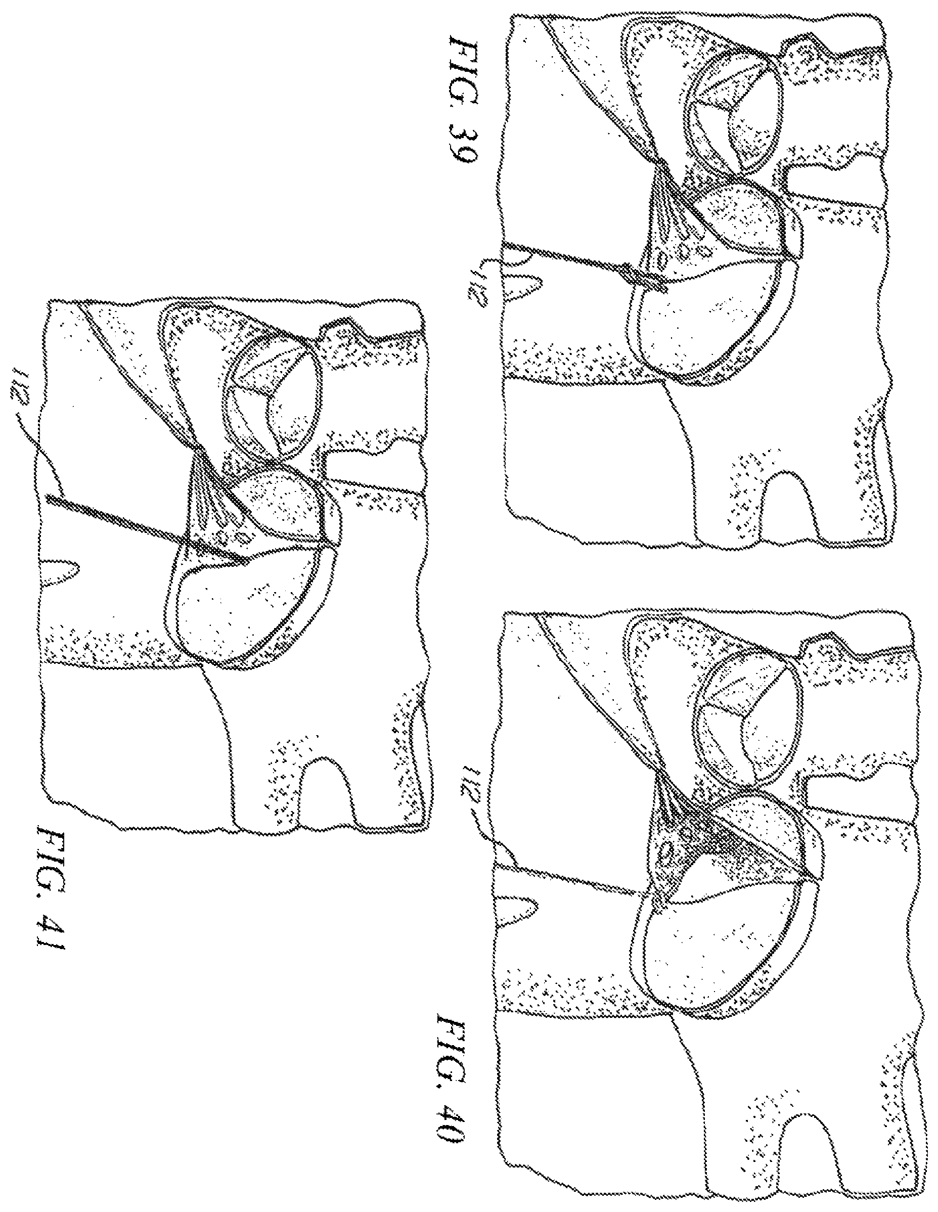 Patent US12426874 Figure 20 – Minimally invasive repair of a valve leaflet in a beating heart
