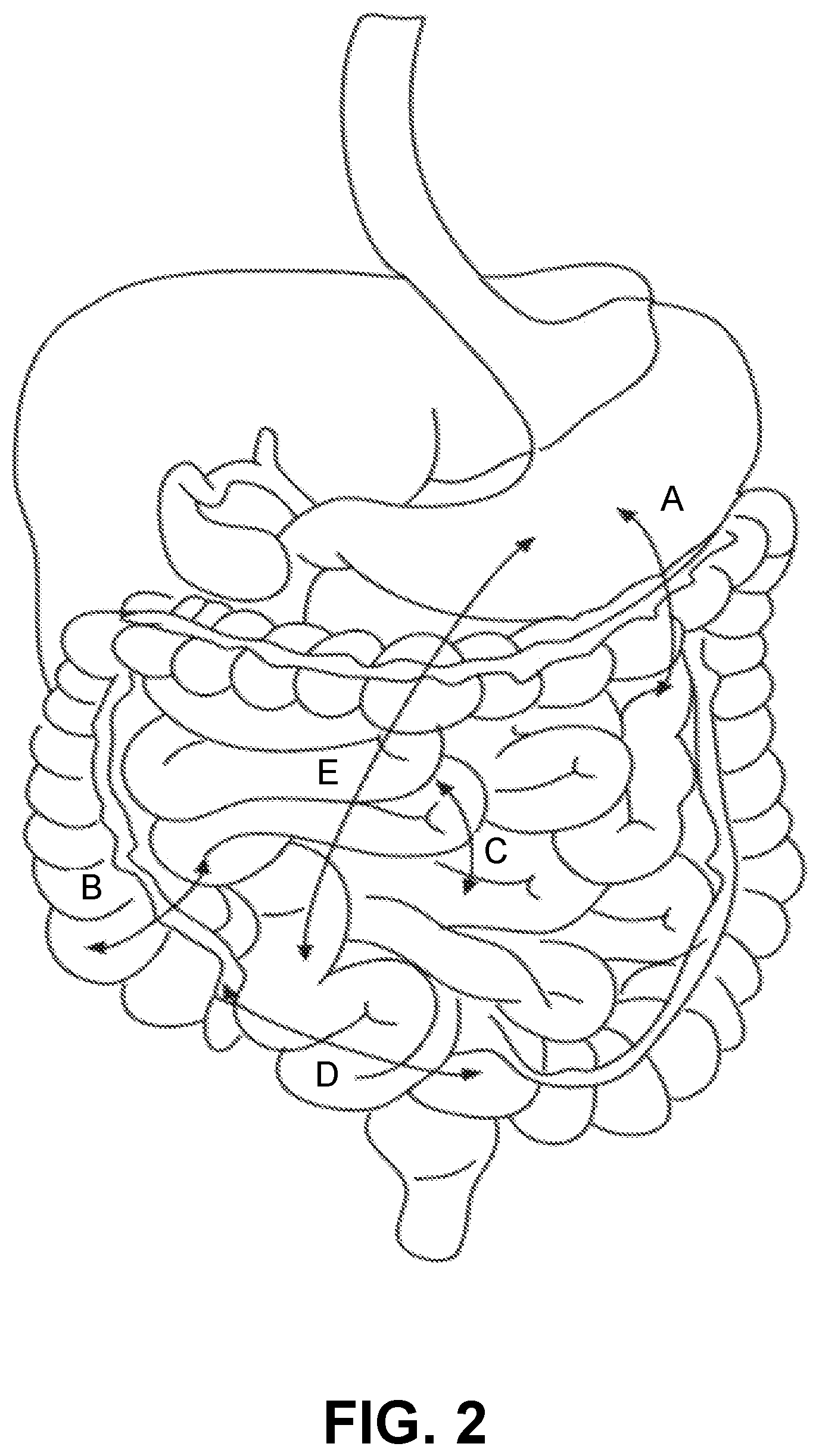 Patent US12426884 Figure 2 – Systems, devices, and methods for forming anastomoses