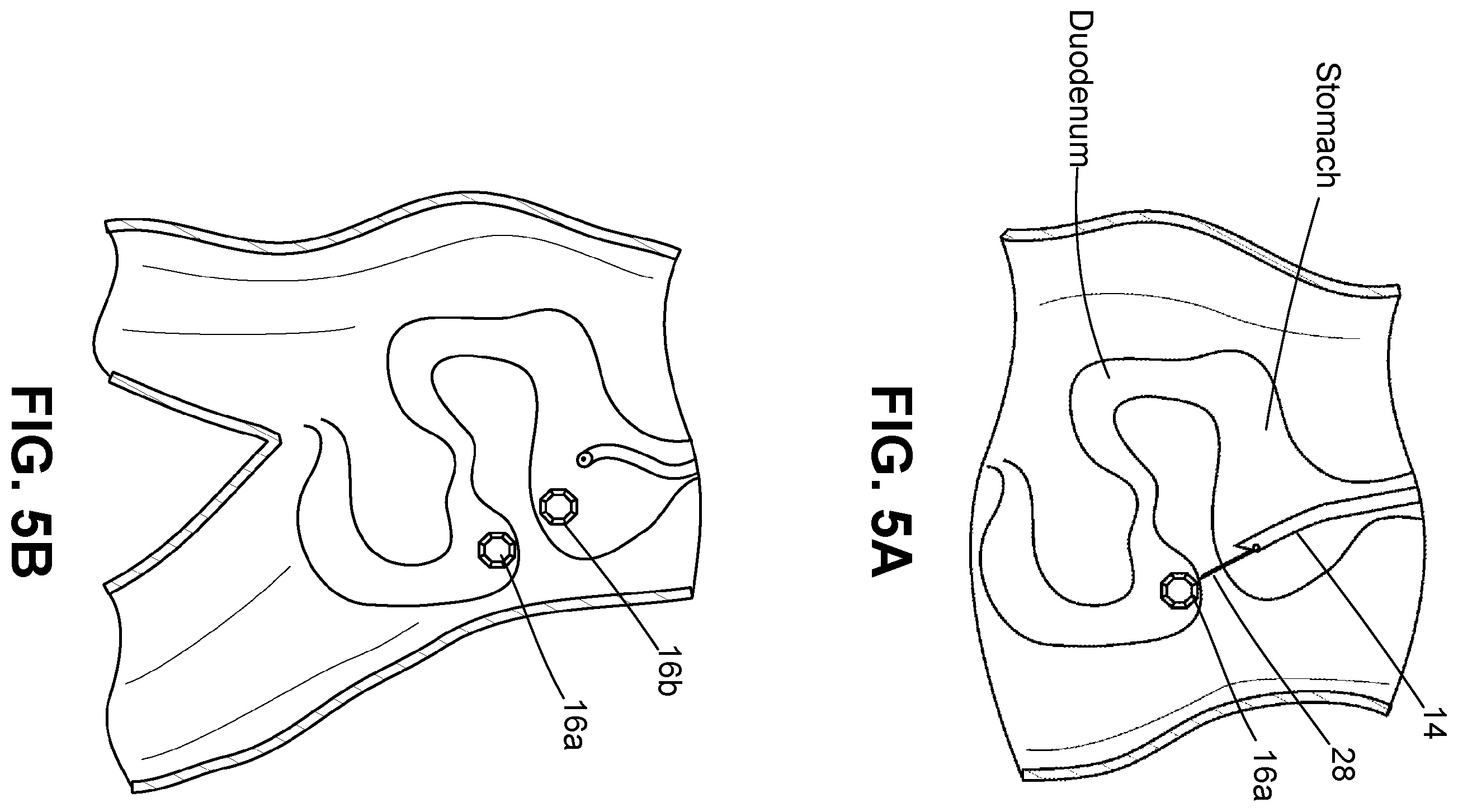 Patent US12426884 Figure 5 – Systems, devices, and methods for forming anastomoses