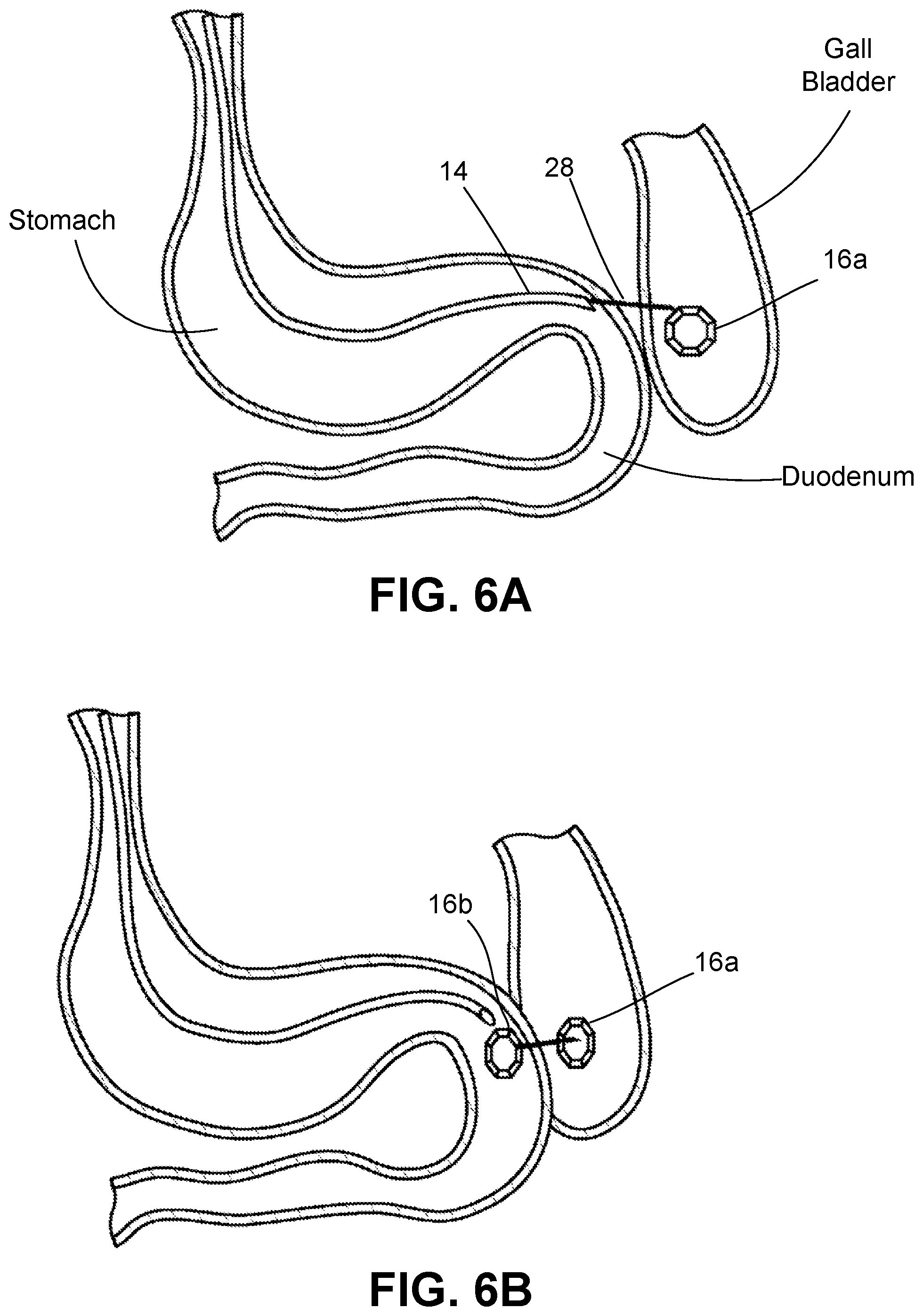 Patent US12426884 Figure 6 – Systems, devices, and methods for forming anastomoses