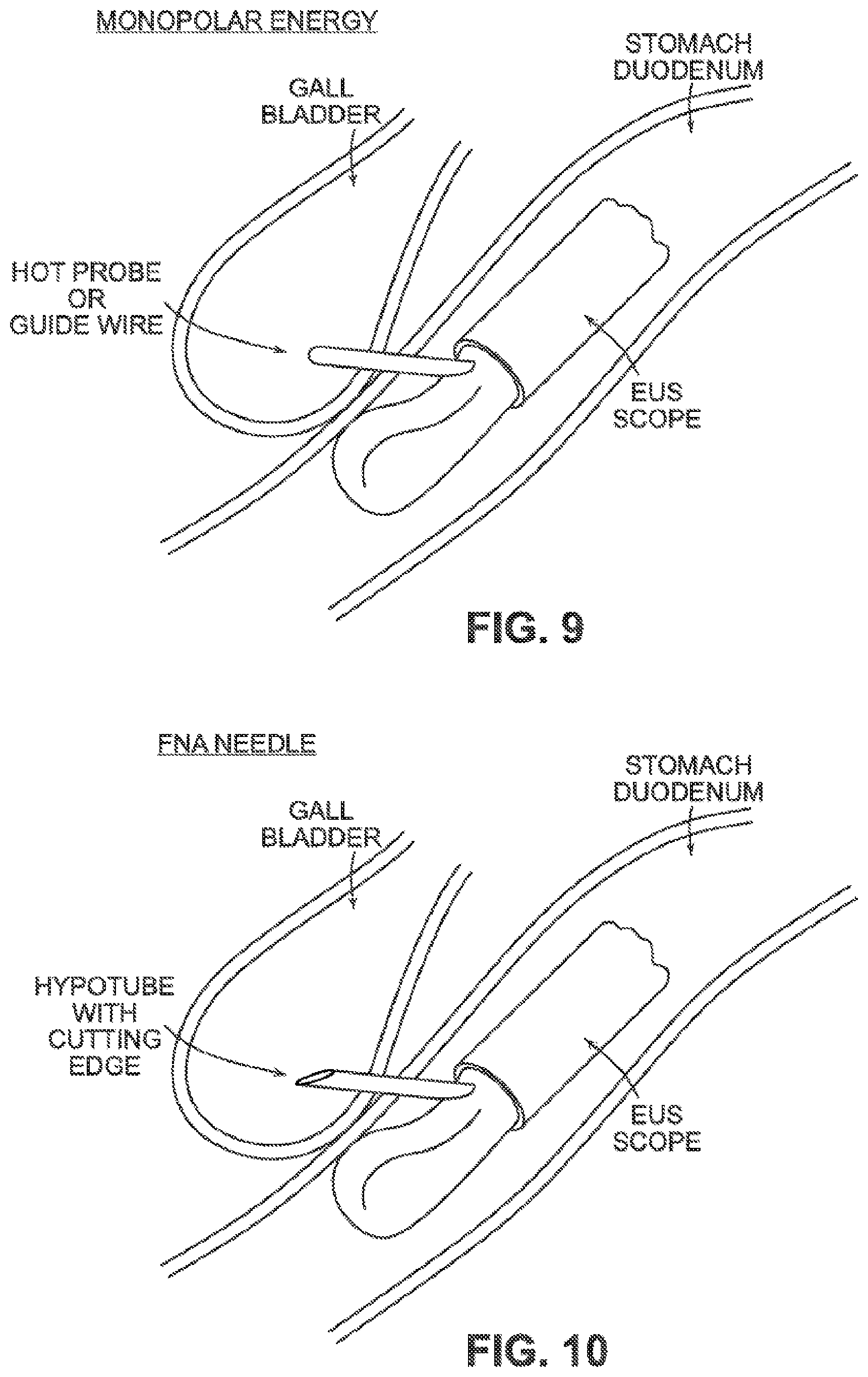 Patent US12426884 Figure 10 – Systems, devices, and methods for forming anastomoses