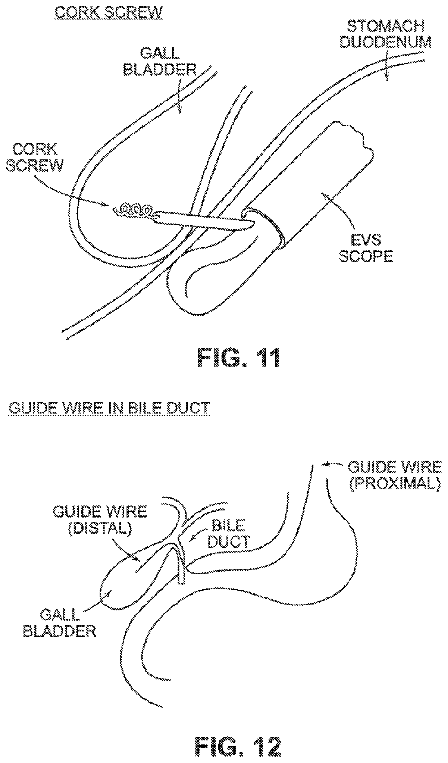 Patent US12426884 Figure 11 – Systems, devices, and methods for forming anastomoses