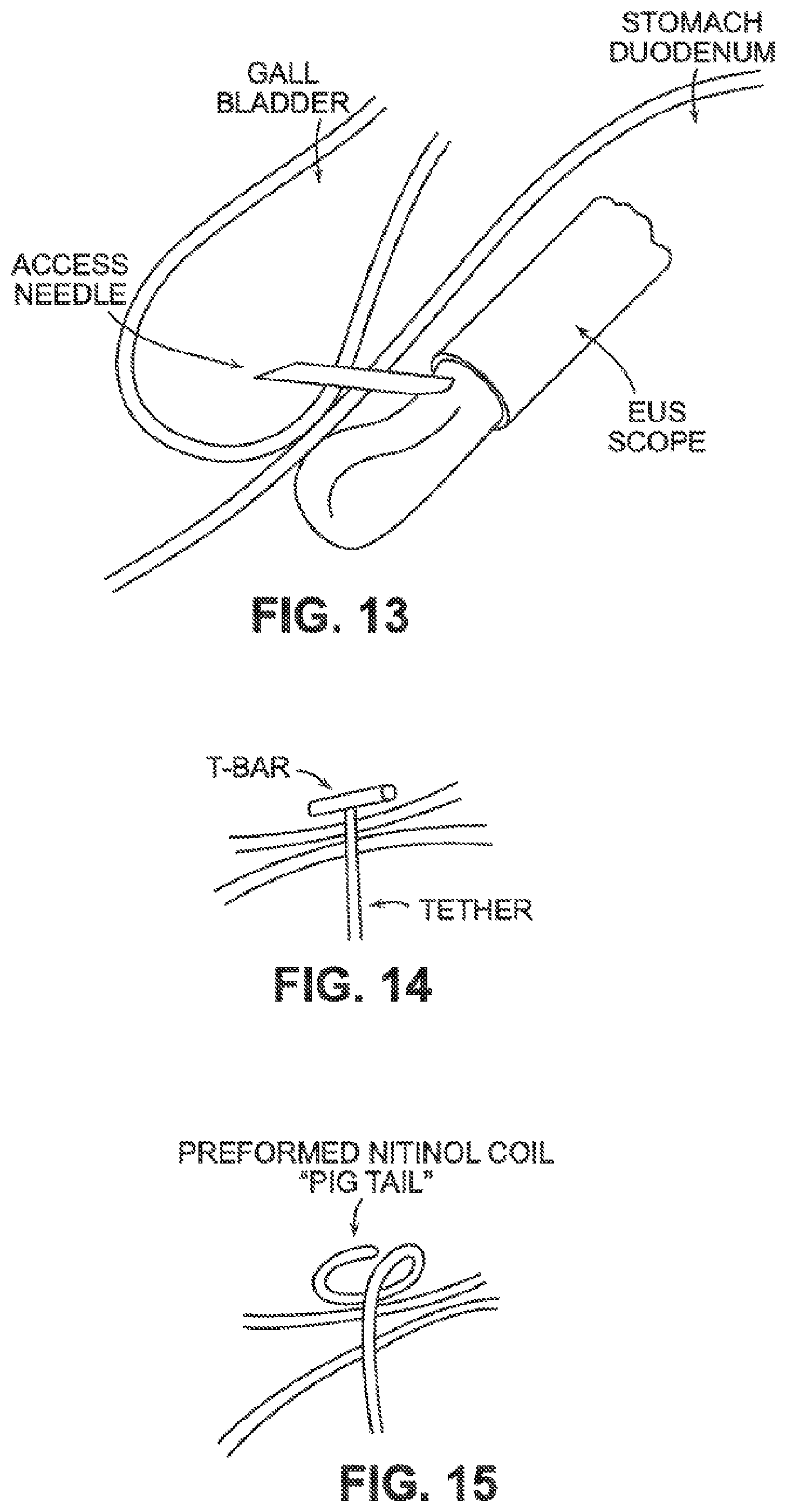 Patent US12426884 Figure 12 – Systems, devices, and methods for forming anastomoses
