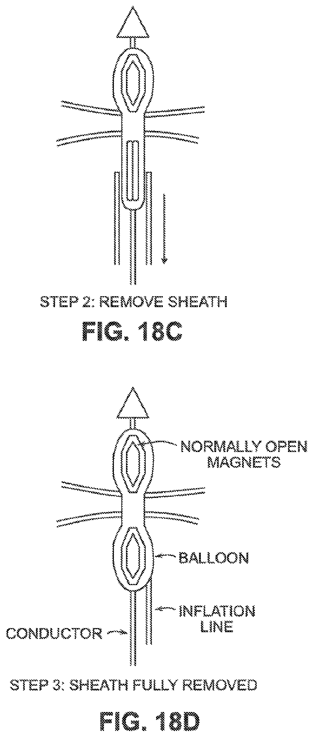 Patent US12426884 Figure 15 – Systems, devices, and methods for forming anastomoses
