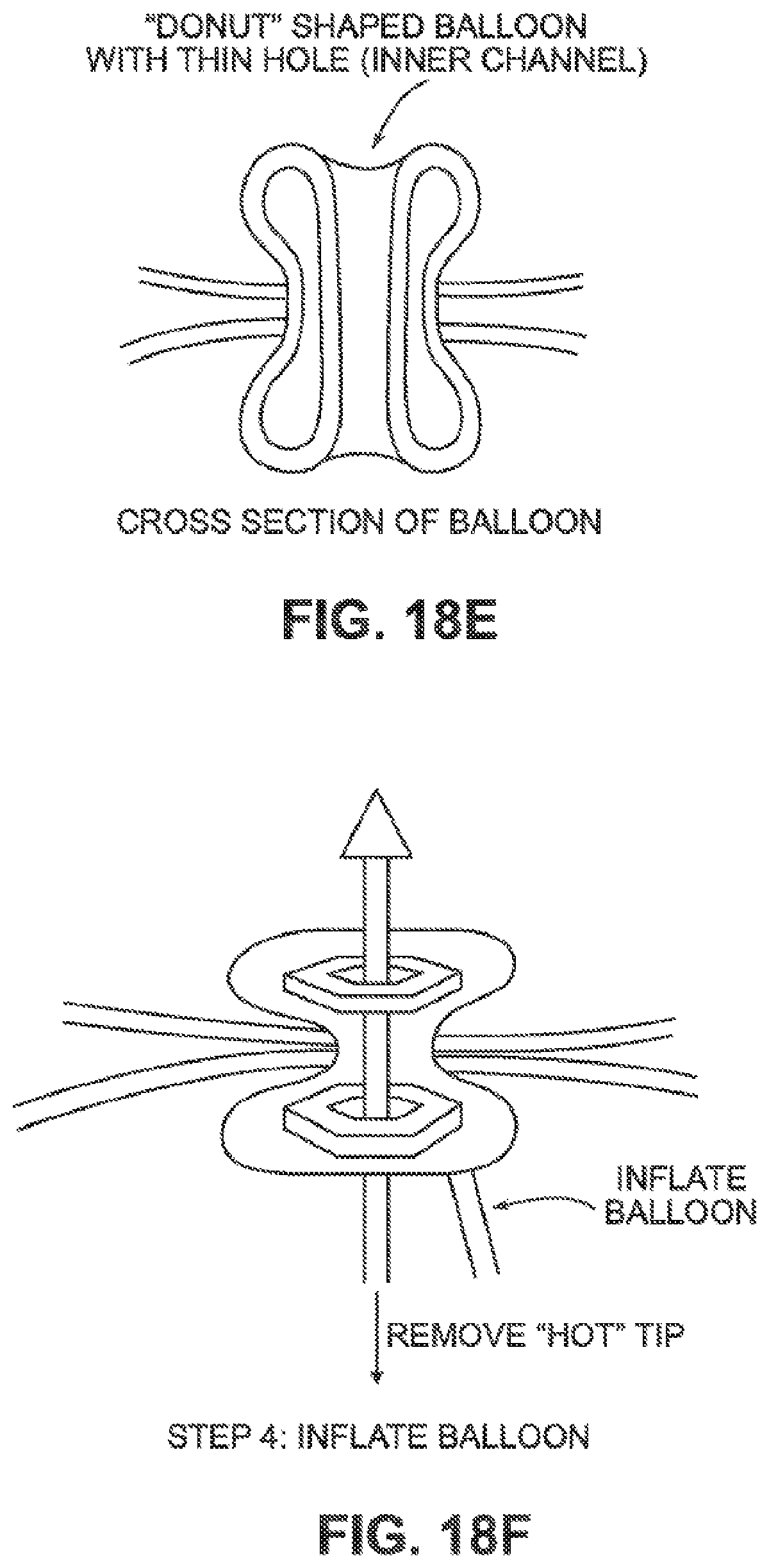 Patent US12426884 Figure 16 – Systems, devices, and methods for forming anastomoses