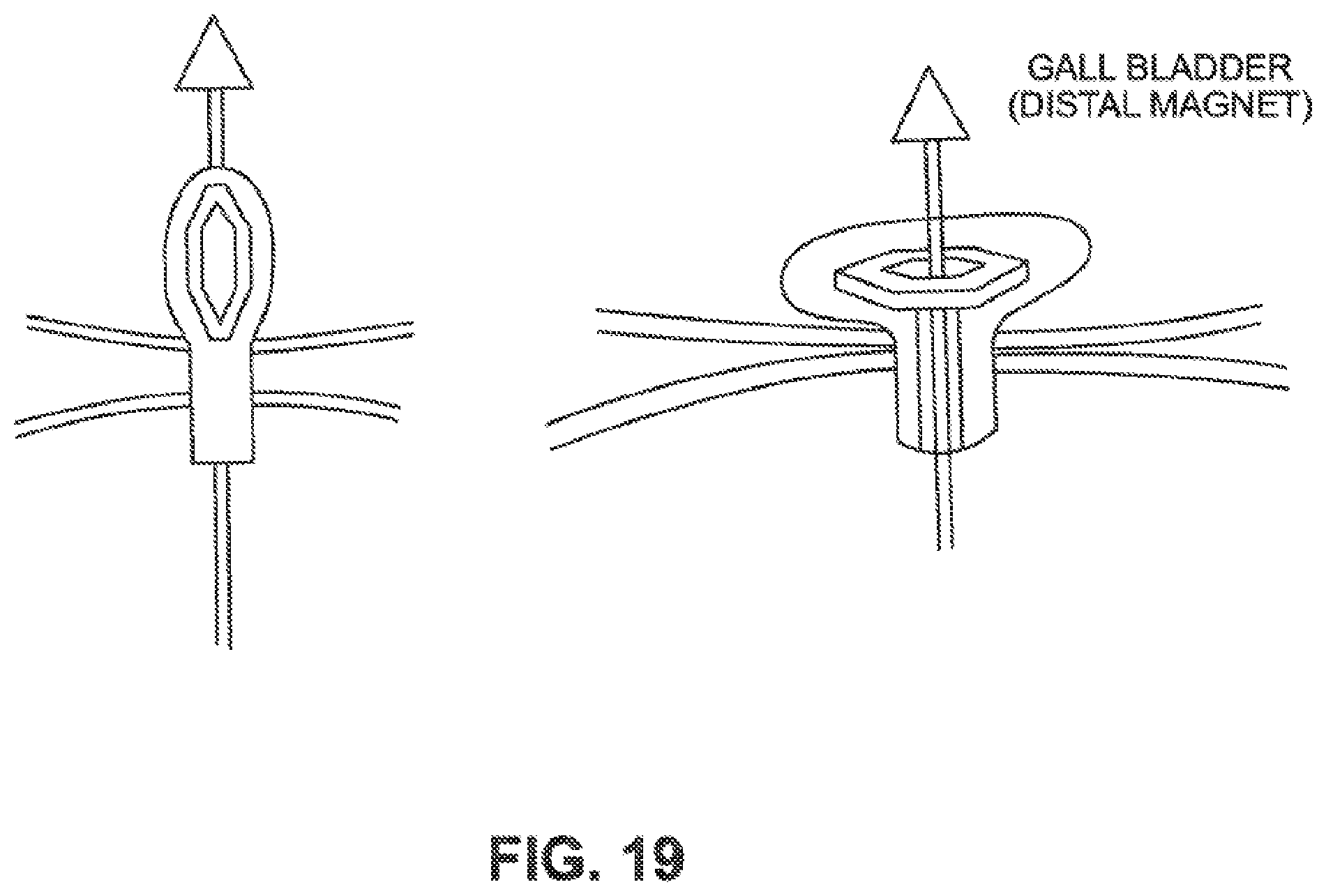 Patent US12426884 Figure 17 – Systems, devices, and methods for forming anastomoses