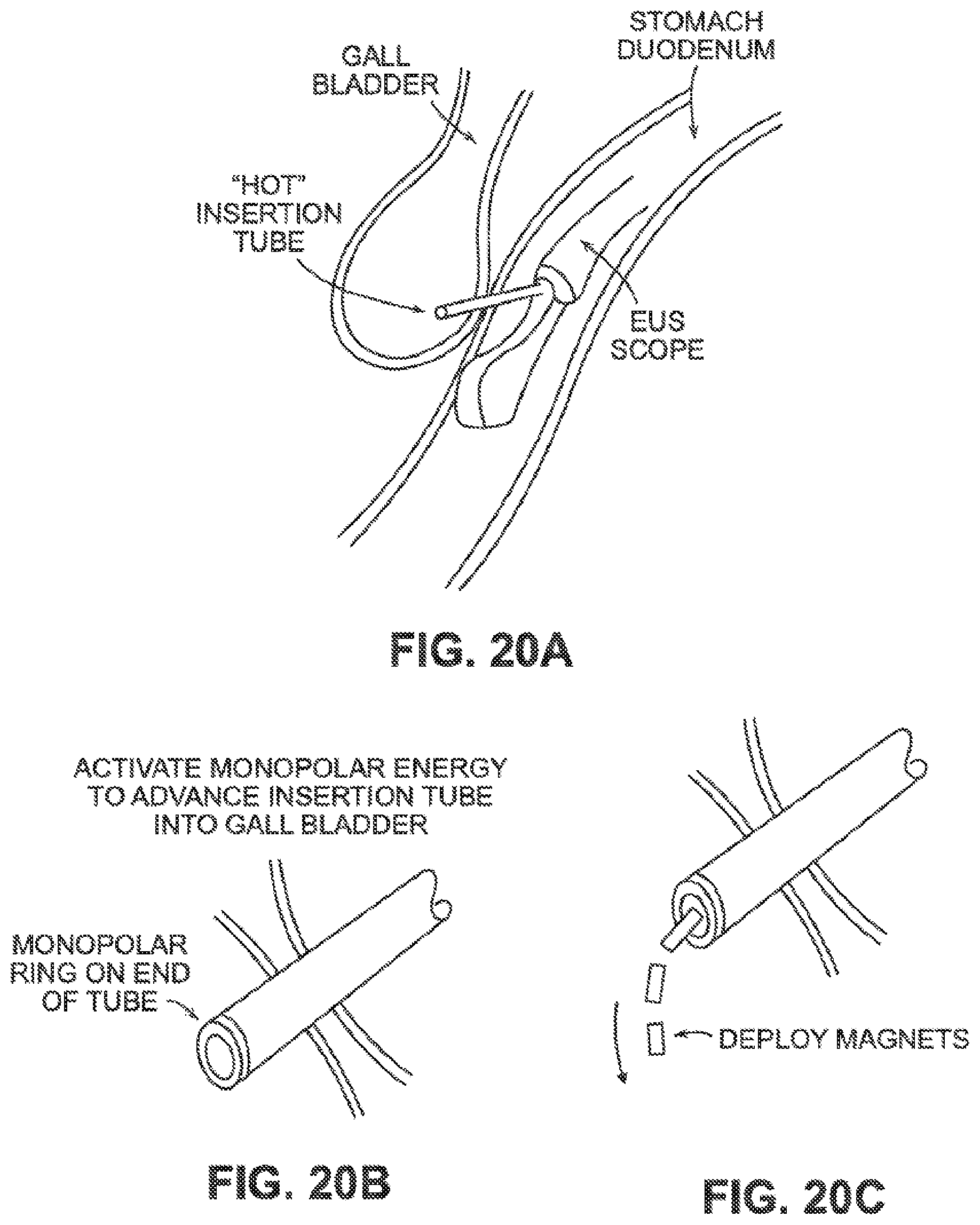 Patent US12426884 Figure 18 – Systems, devices, and methods for forming anastomoses