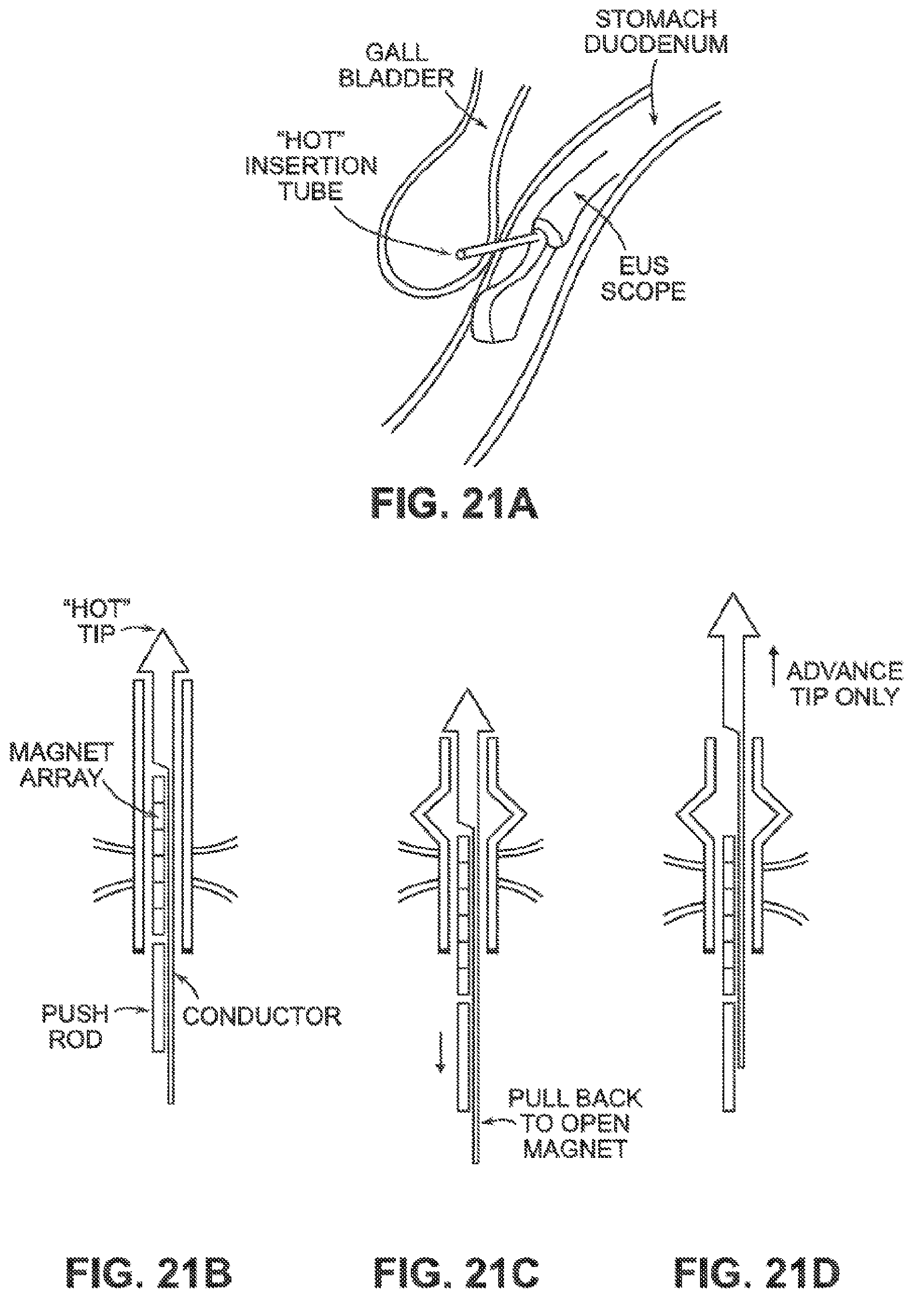 Patent US12426884 Figure 19 – Systems, devices, and methods for forming anastomoses