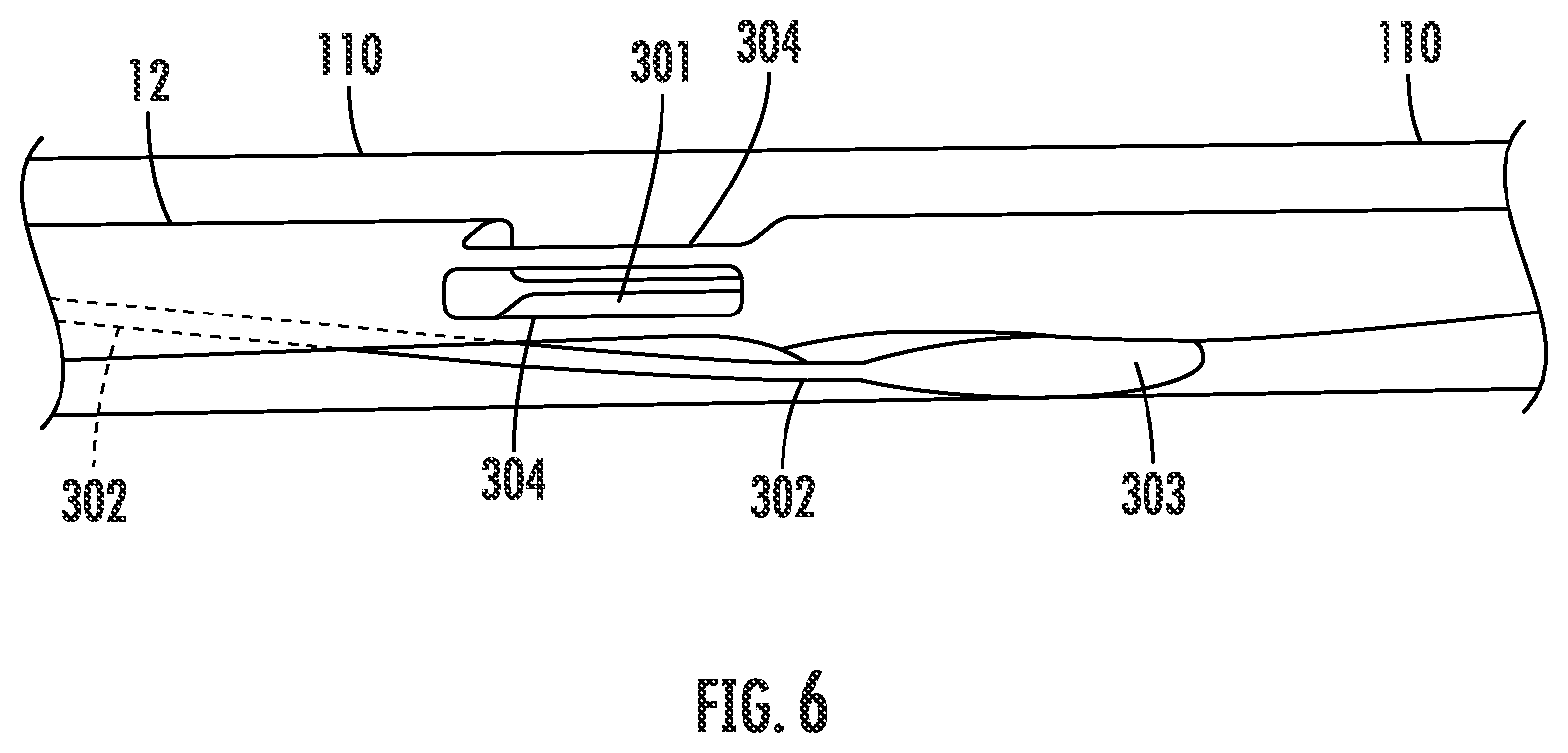 Patent US12426885 Figure 6 – Mesh cap for ameliorating outpouchings