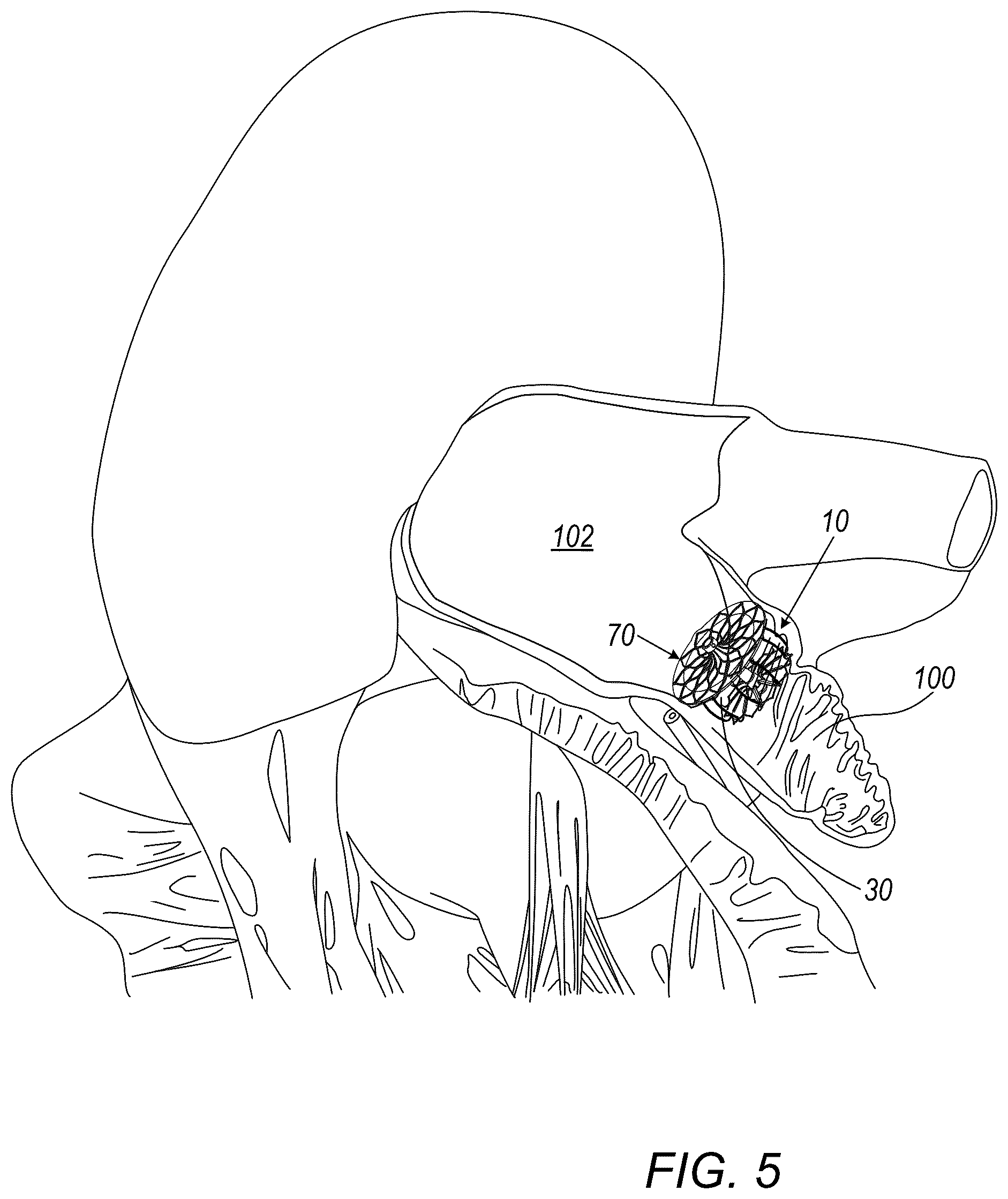 Patent US12426887 Figure 8 – Left atrial appendage occlusion devices