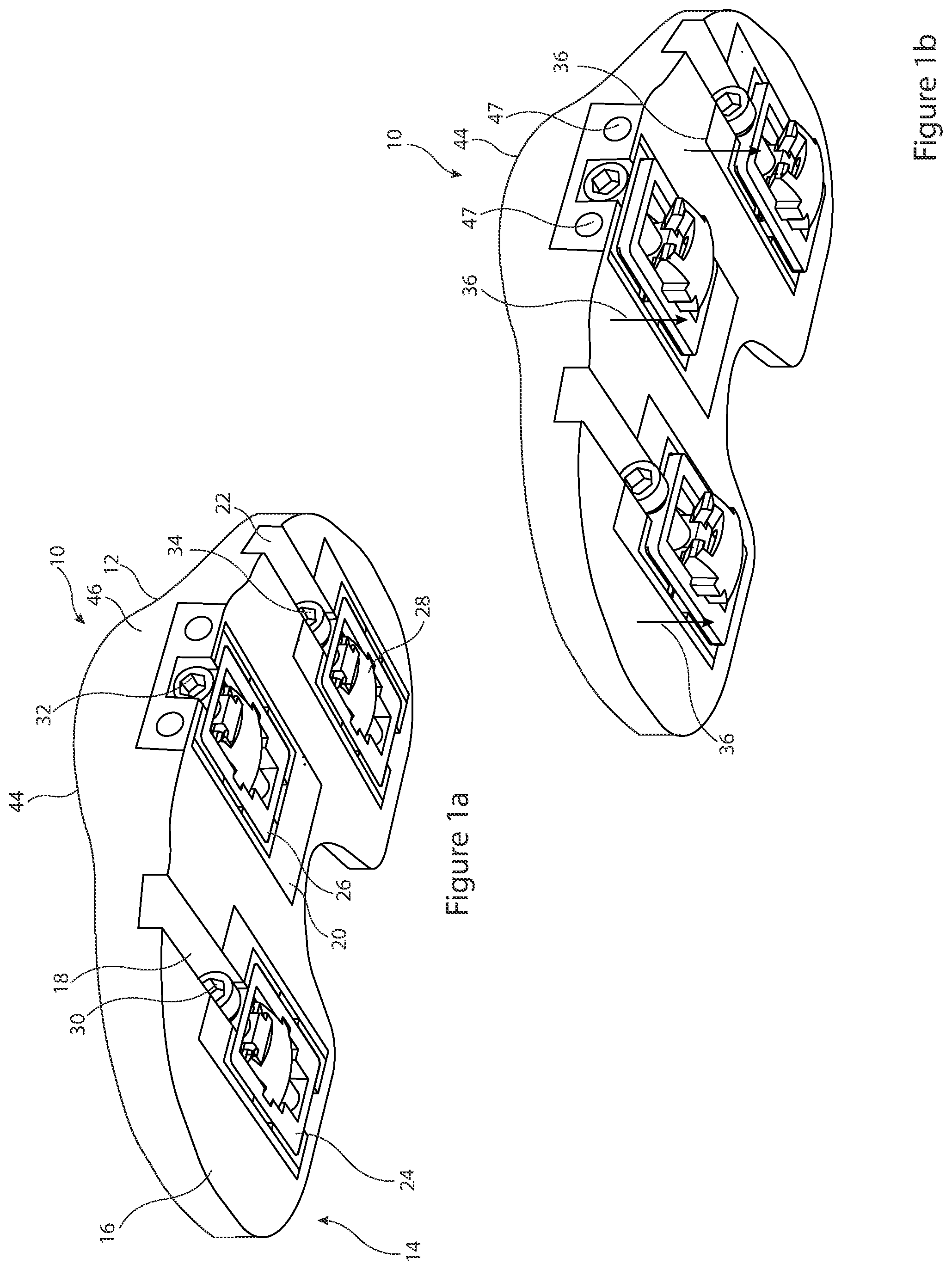 Patent US12426895 Figure 1 – Arrangement and method used in the preparation of bone surfaces of the knee joint for the components of a prosthetic knee joint