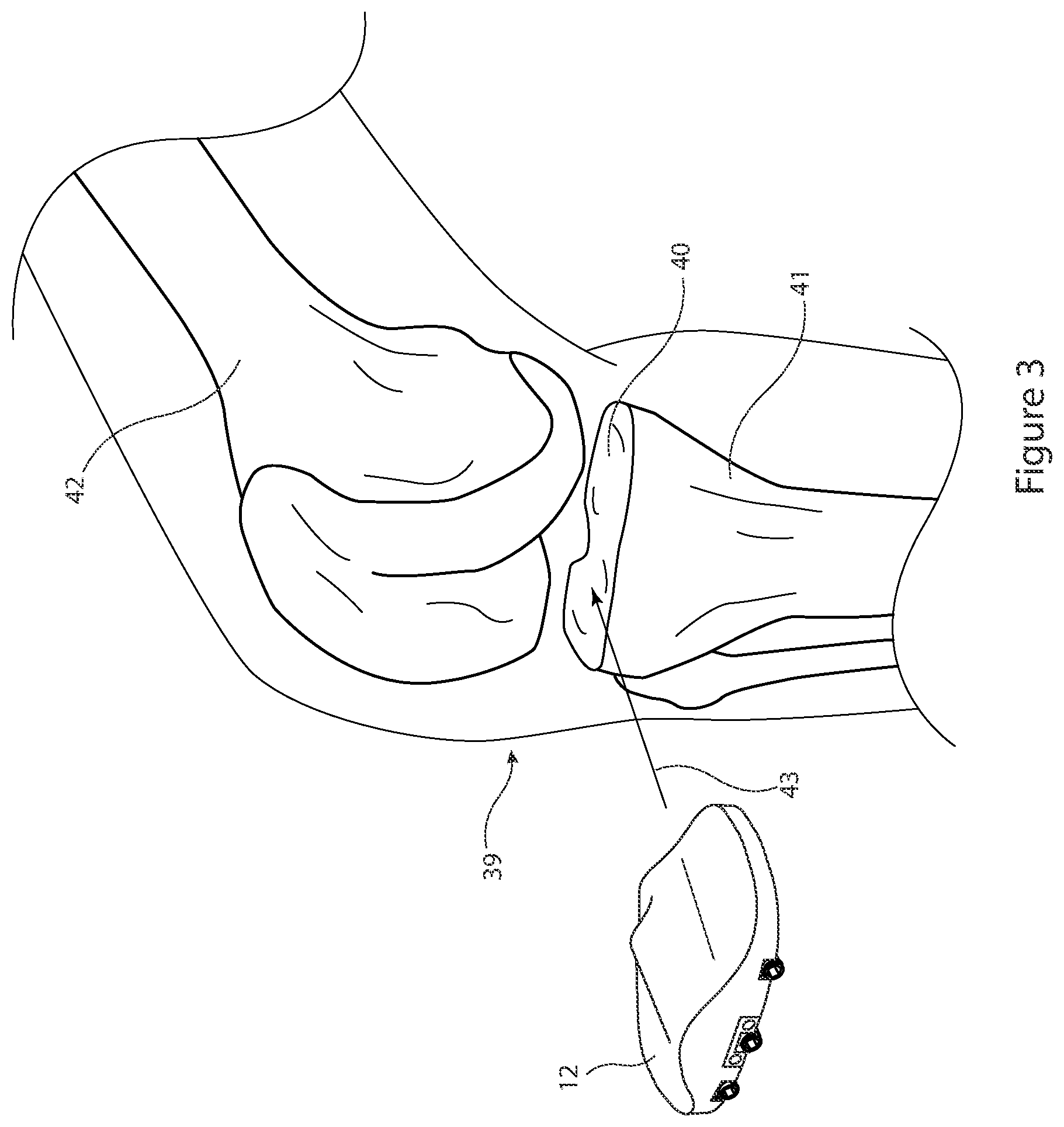 Patent US12426895 Figure 3 – Arrangement and method used in the preparation of bone surfaces of the knee joint for the components of a prosthetic knee joint