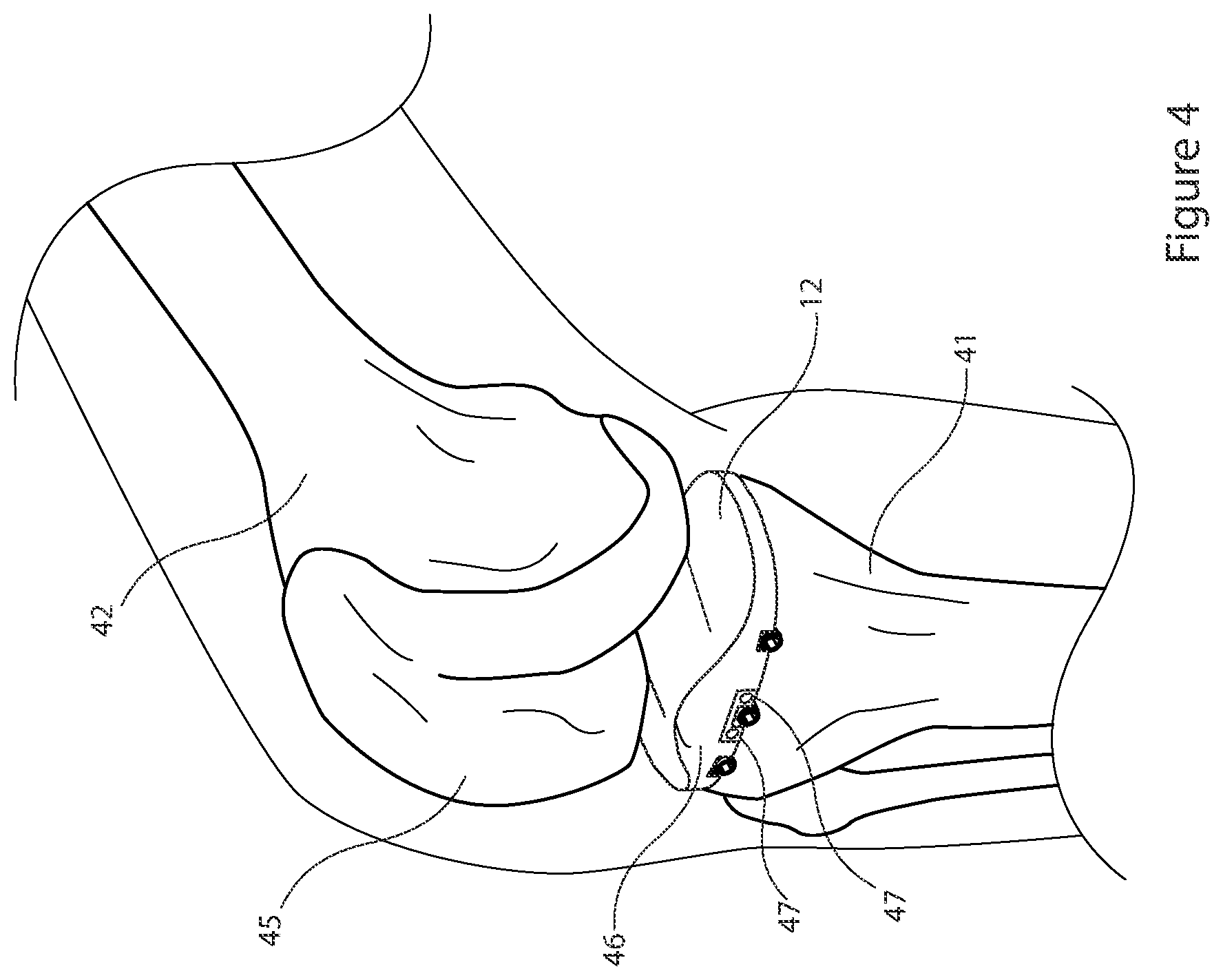 Patent US12426895 Figure 4 – Arrangement and method used in the preparation of bone surfaces of the knee joint for the components of a prosthetic knee joint