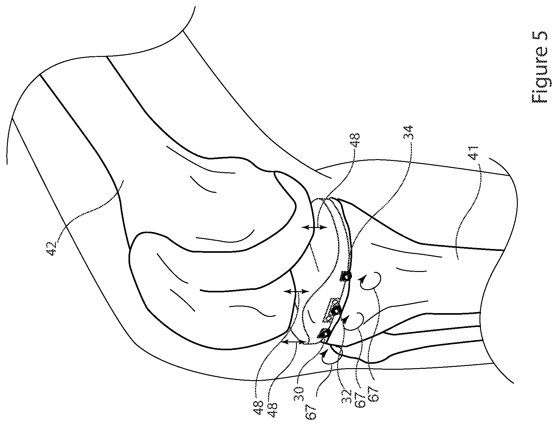 Patent US12426895 Figure 5 – Arrangement and method used in the preparation of bone surfaces of the knee joint for the components of a prosthetic knee joint