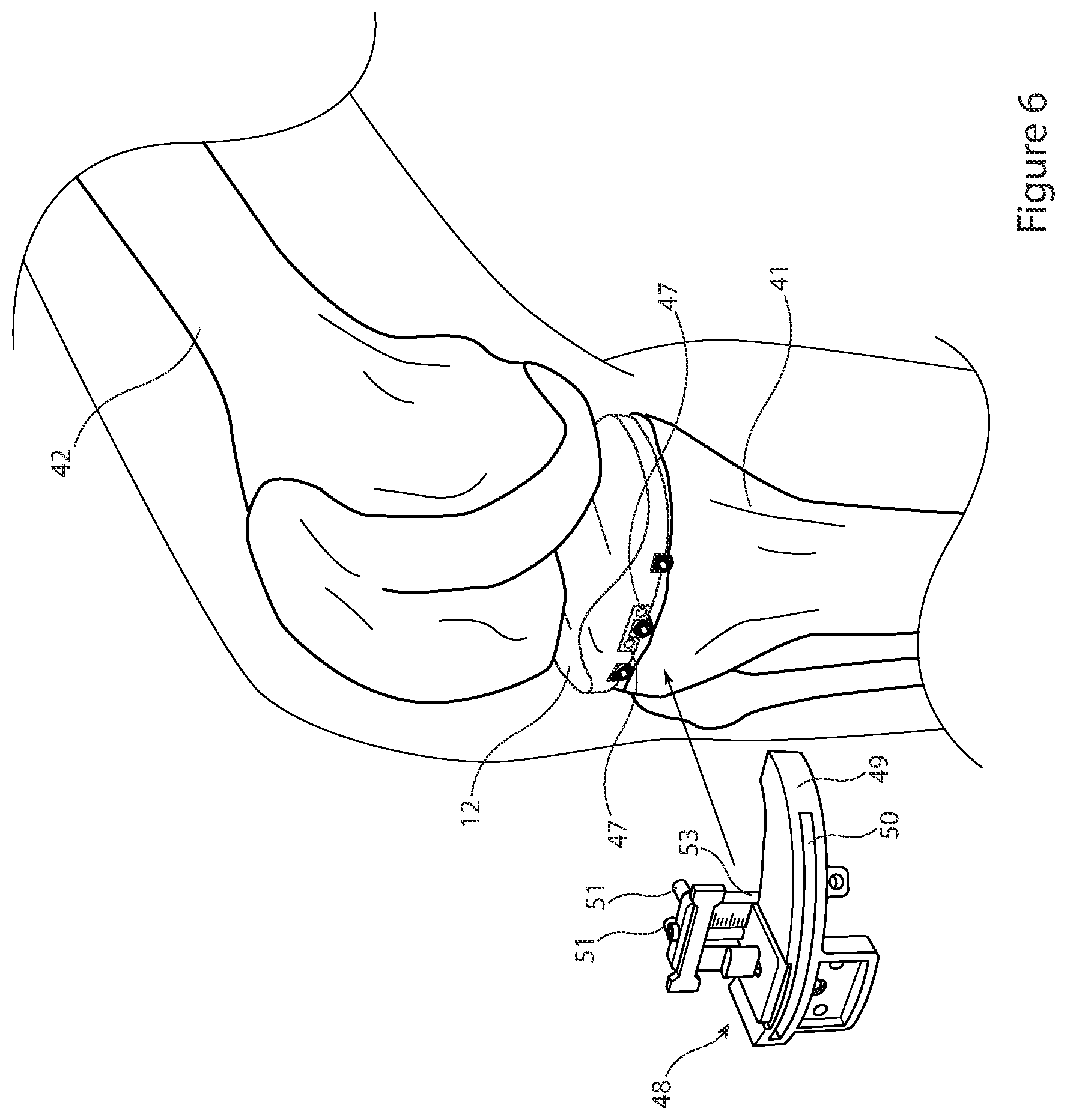 Patent US12426895 Figure 6 – Arrangement and method used in the preparation of bone surfaces of the knee joint for the components of a prosthetic knee joint