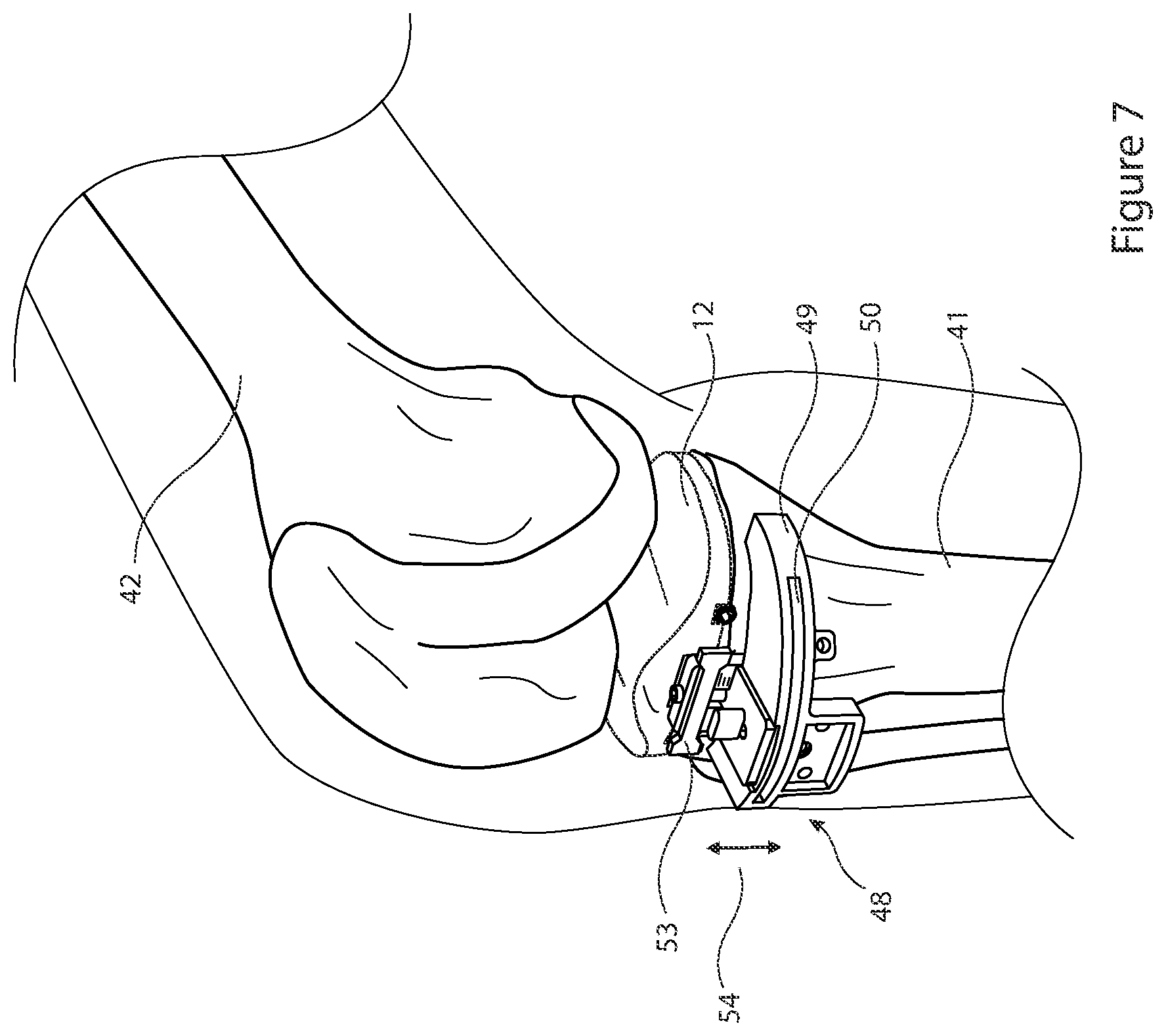 Patent US12426895 Figure 7 – Arrangement and method used in the preparation of bone surfaces of the knee joint for the components of a prosthetic knee joint