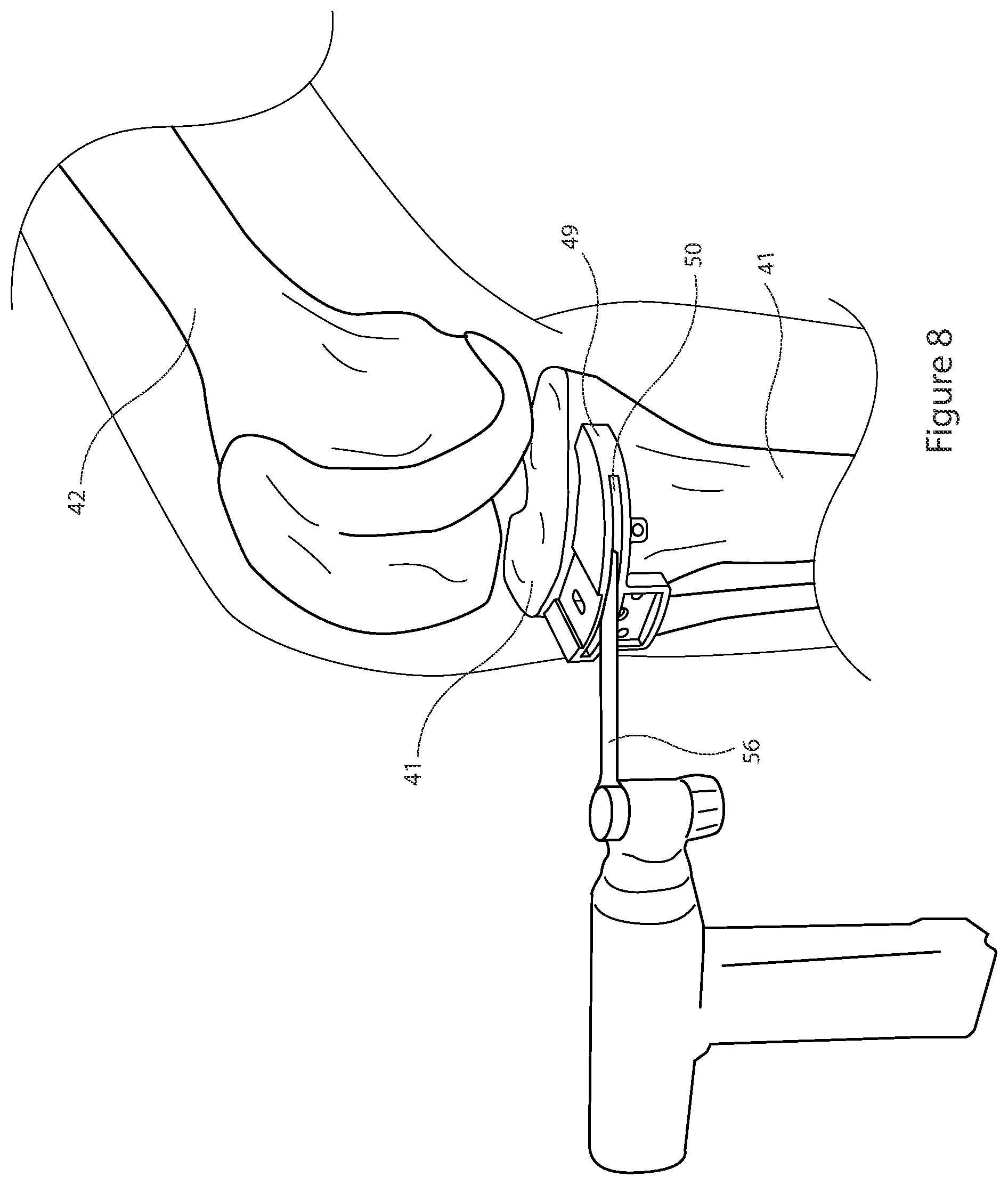 Patent US12426895 Figure 8 – Arrangement and method used in the preparation of bone surfaces of the knee joint for the components of a prosthetic knee joint
