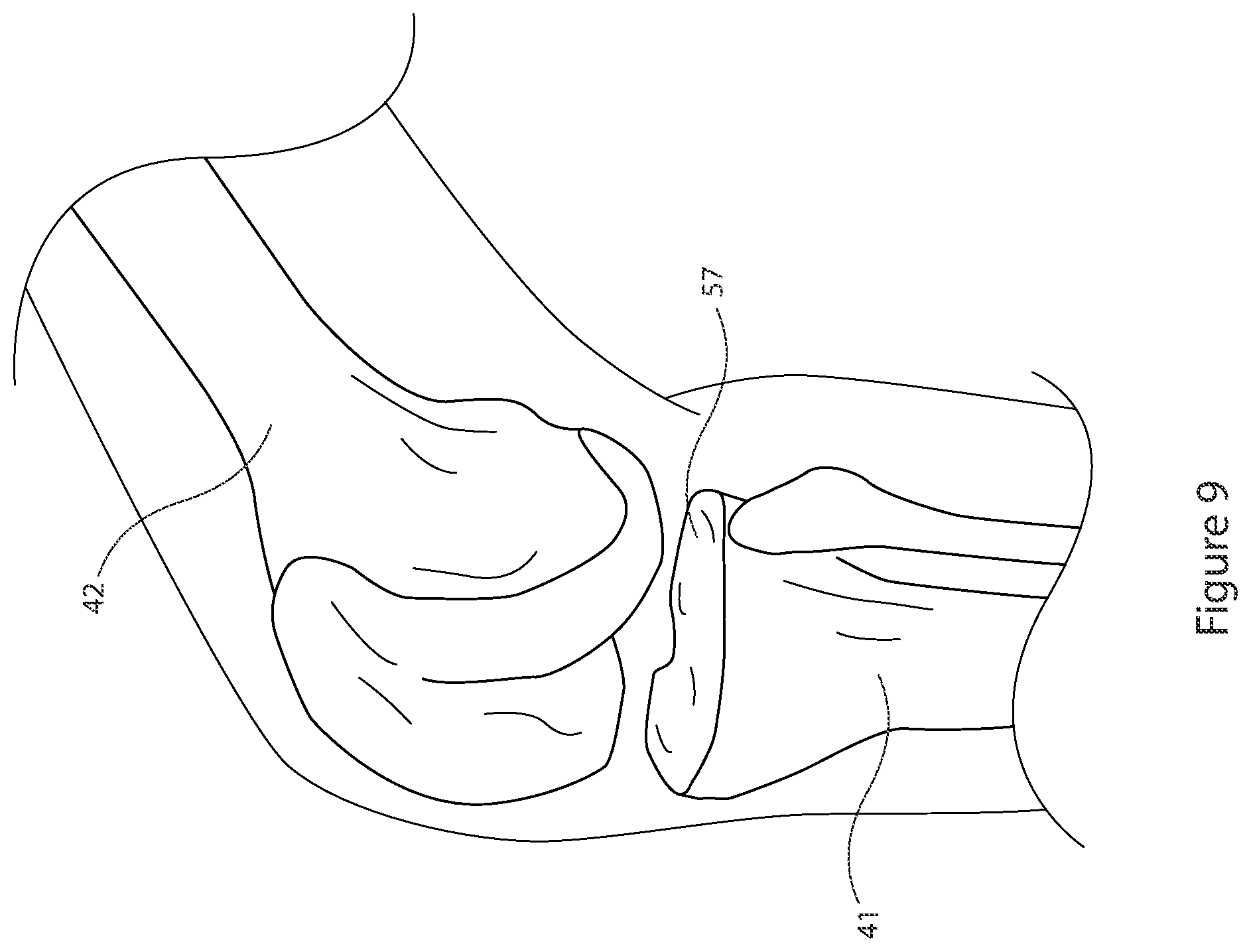 Patent US12426895 Figure 9 – Arrangement and method used in the preparation of bone surfaces of the knee joint for the components of a prosthetic knee joint