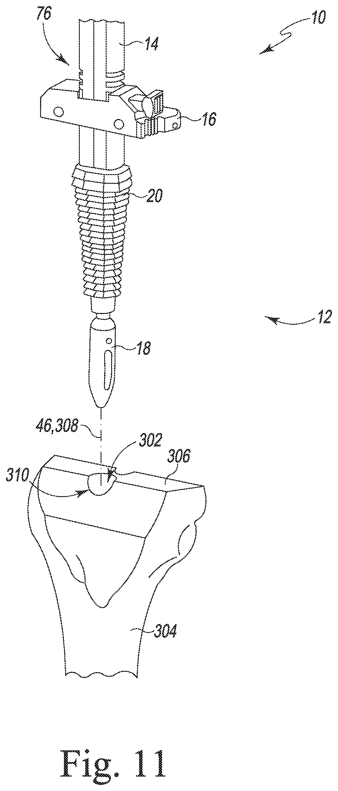 Patent US12426899 Figure 10 – Femoral surgical instrument and method of assembling same