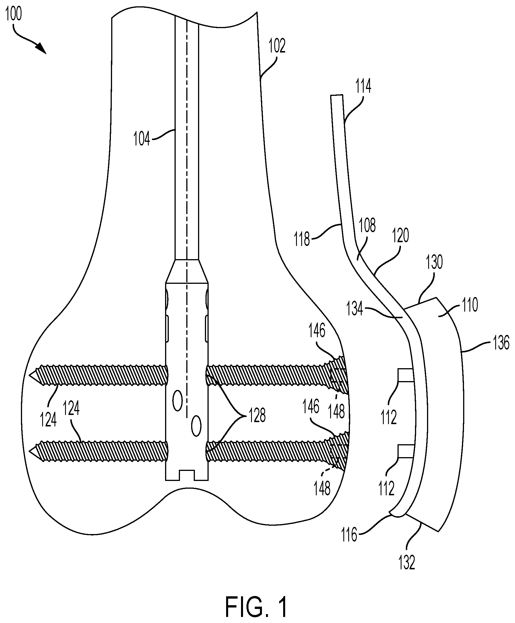 Patent US12426901 Figure 1 – Plate to nail alignment pin/k-wire