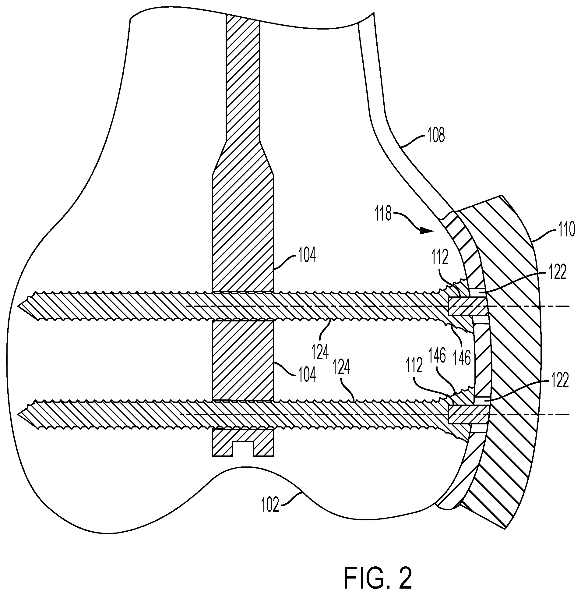 Patent US12426901 Figure 2 – Plate to nail alignment pin/k-wire