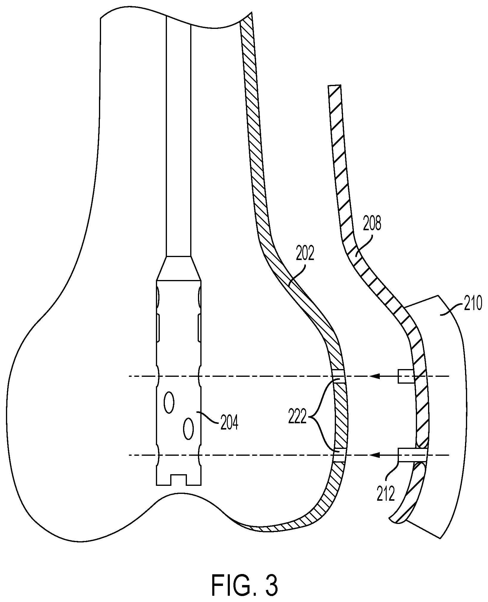 Patent US12426901 Figure 3 – Plate to nail alignment pin/k-wire