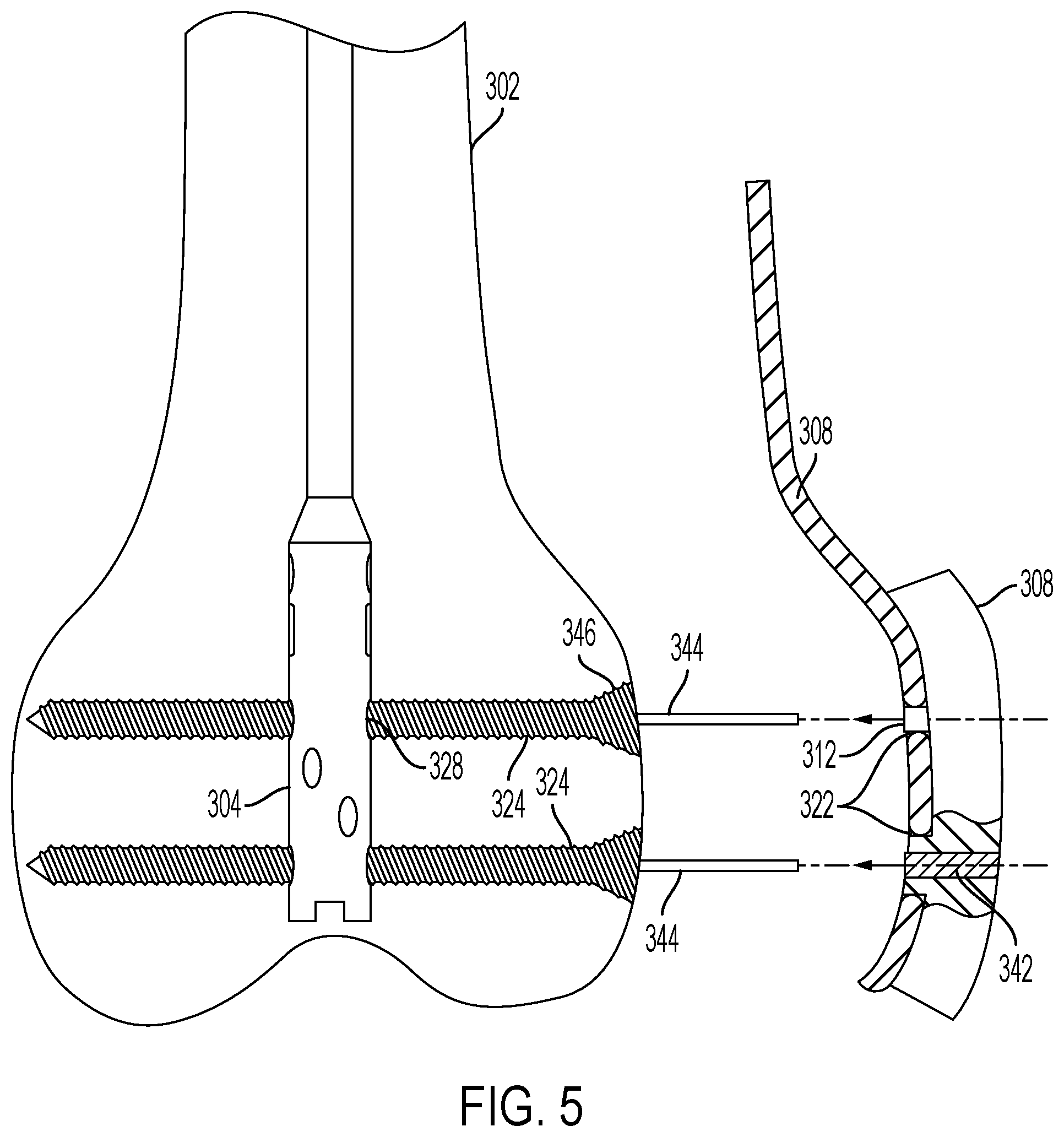 Patent US12426901 Figure 5 – Plate to nail alignment pin/k-wire