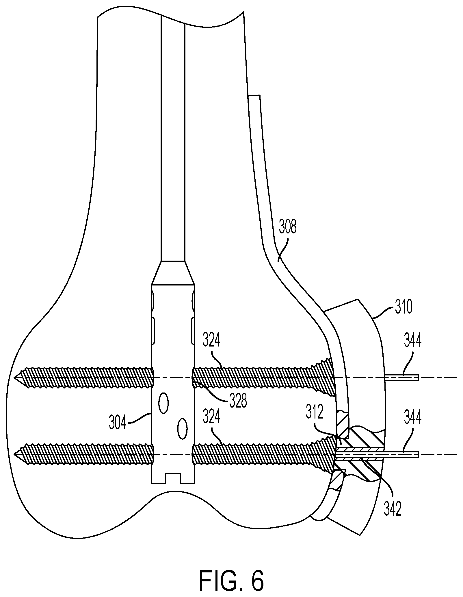 Patent US12426901 Figure 6 – Plate to nail alignment pin/k-wire