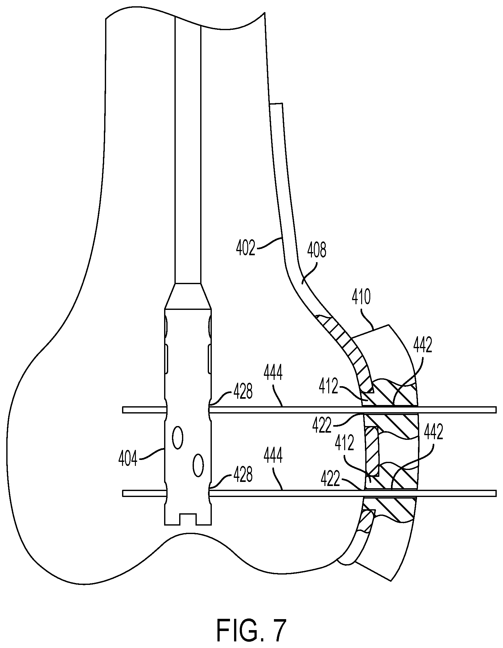 Patent US12426901 Figure 7 – Plate to nail alignment pin/k-wire