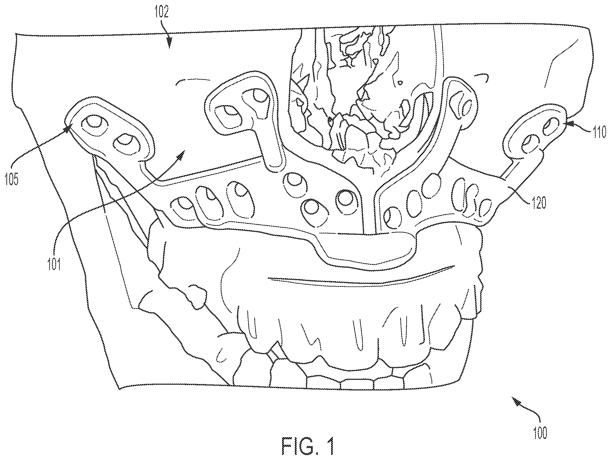 Patent US12426902 Figure 1 – Surgical cutting guides designed for anatomical landmarks