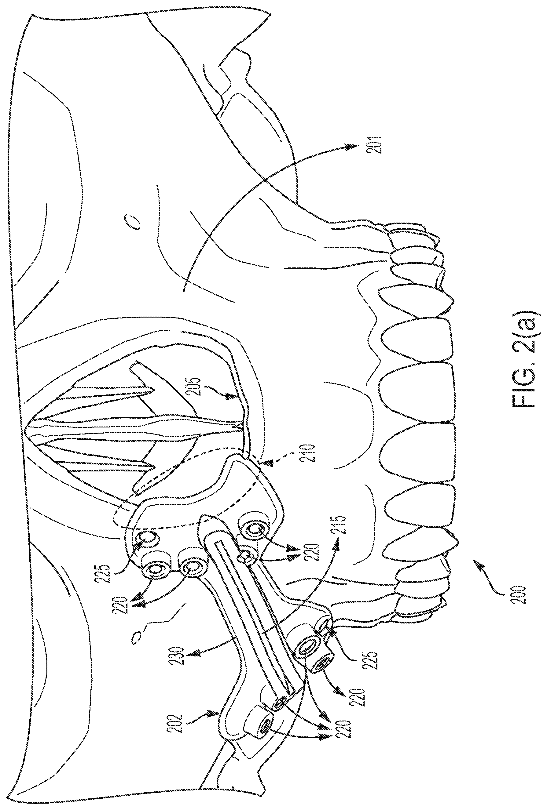 Patent US12426902 Figure 2 – Surgical cutting guides designed for anatomical landmarks