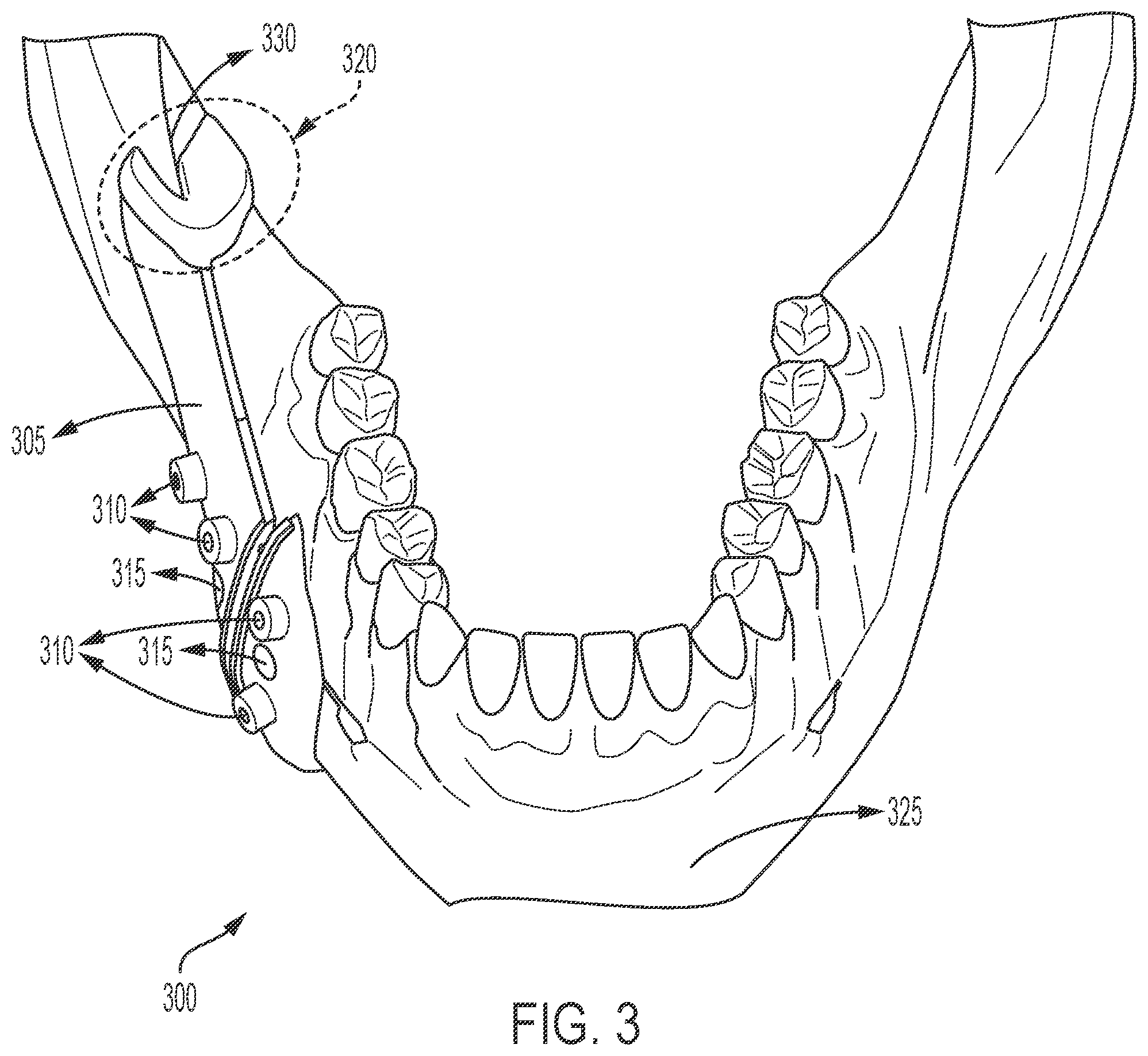 Patent US12426902 Figure 5 – Surgical cutting guides designed for anatomical landmarks