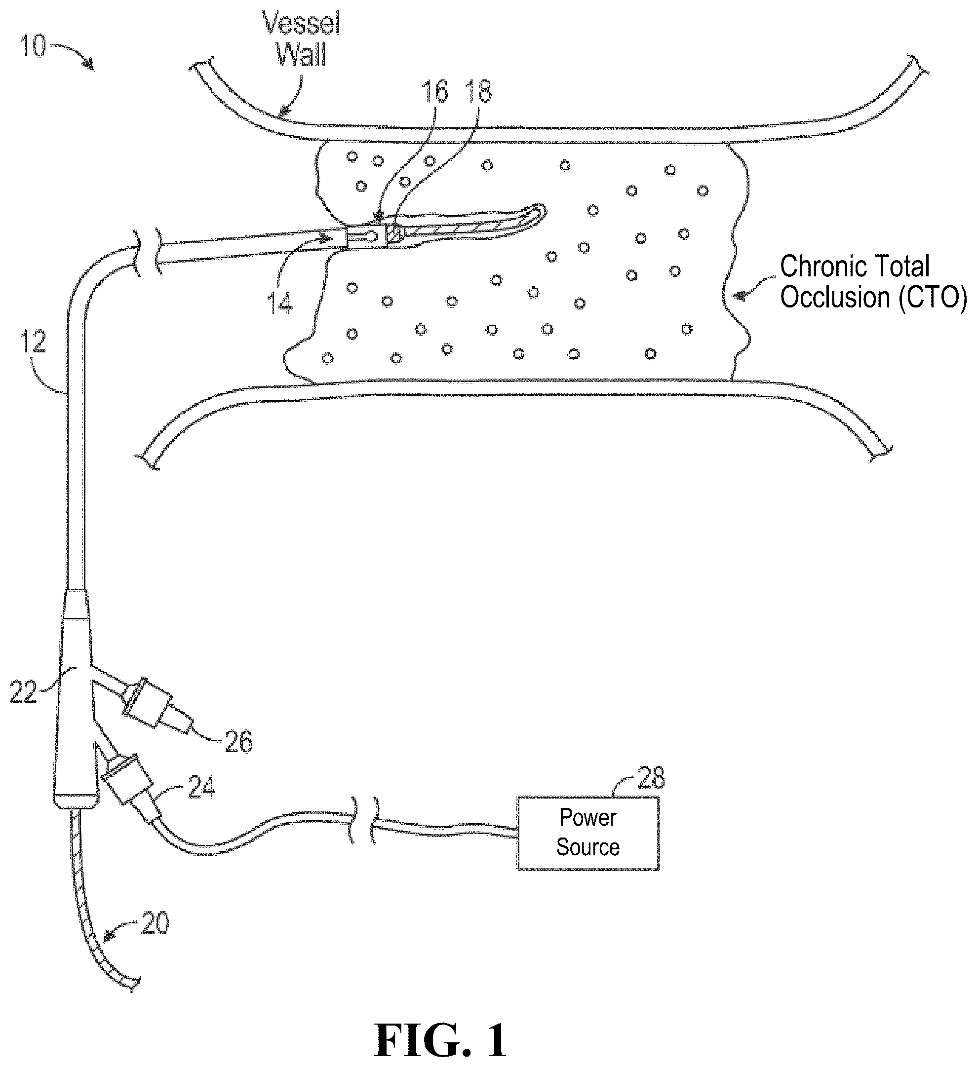 Patent US12426904 — Intravascular lithotripsy catheter with oscillating impactor — Figure 1